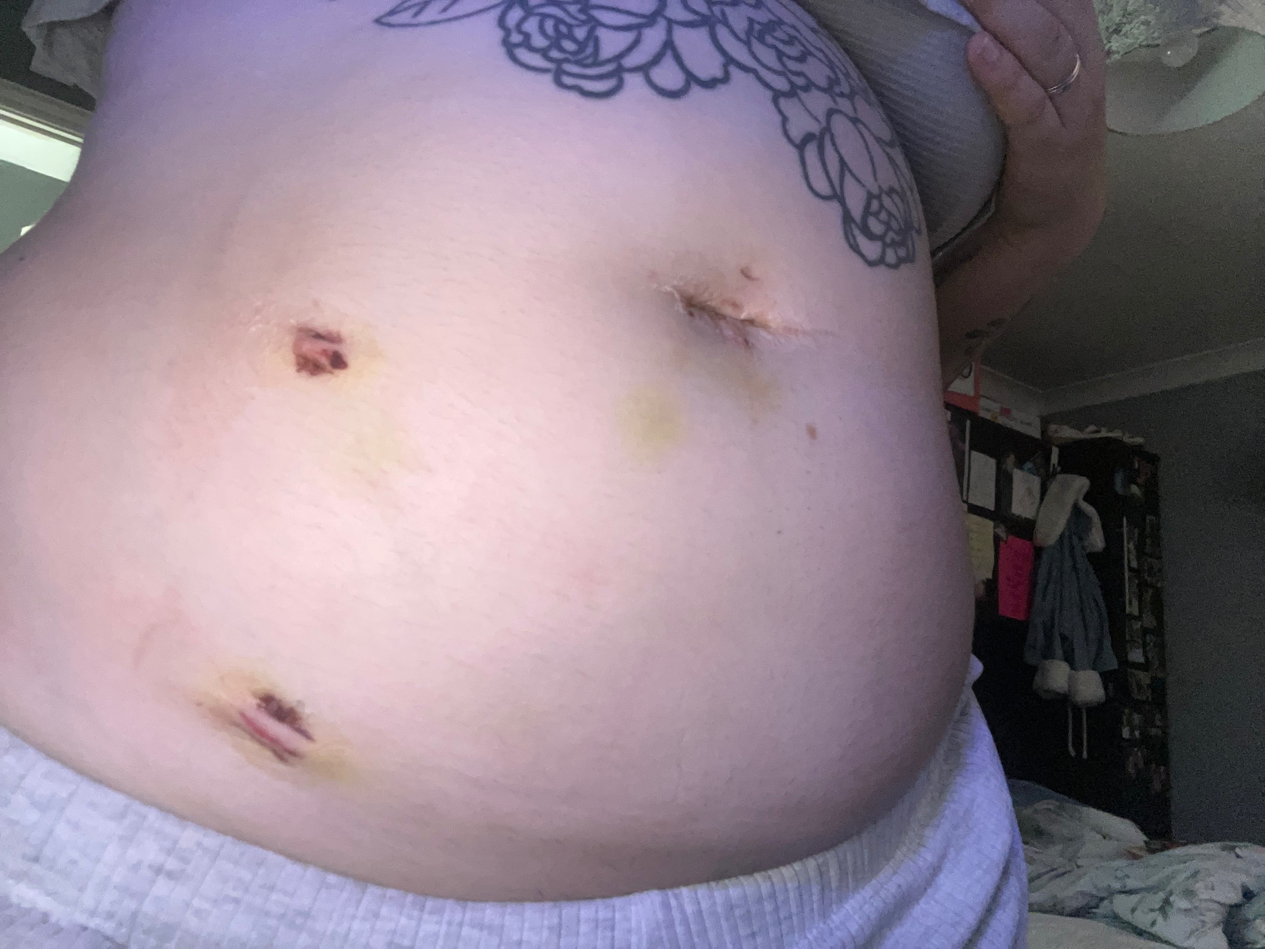 Endometriosis Is Taking Over My Body campaign photo, 4 of 4
