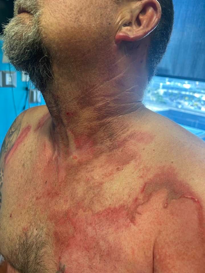 Help support Andy as he recovers from burn injury campaign photo, 7 of 8