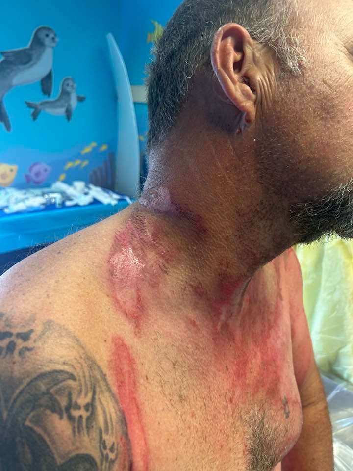 Help support Andy as he recovers from burn injury campaign photo, 2 of 8