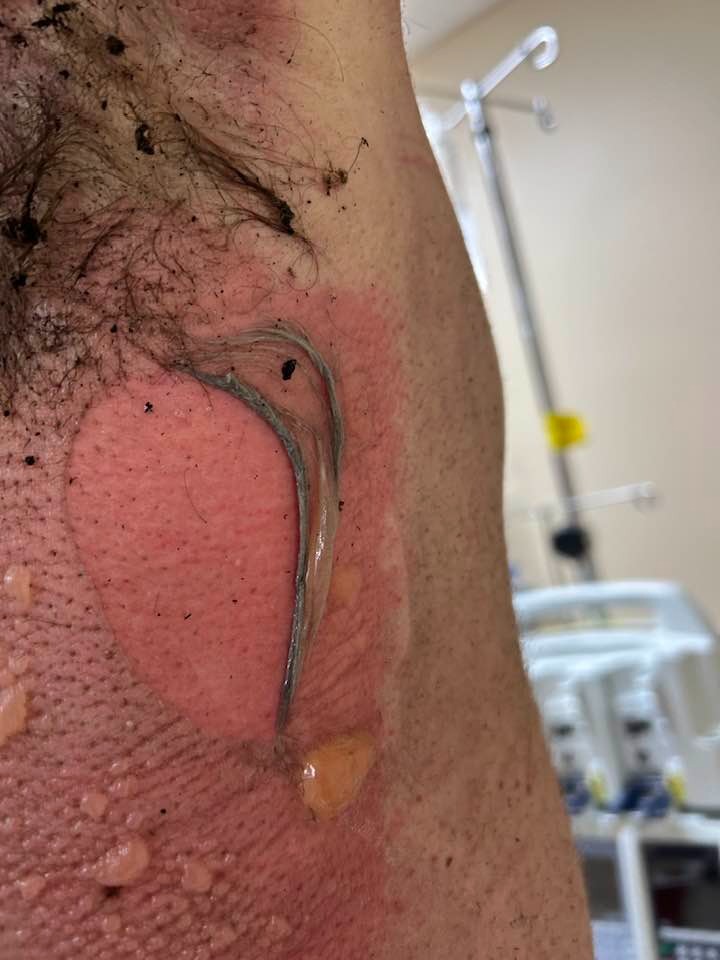 Help support Andy as he recovers from burn injury campaign photo, 4 of 8