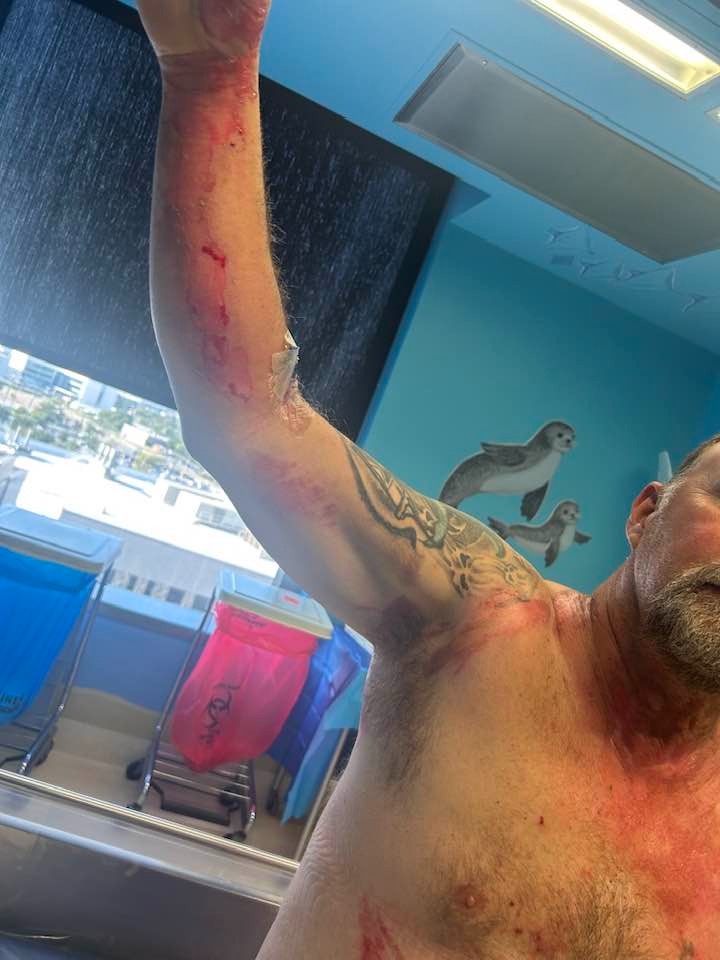 Help support Andy as he recovers from burn injury campaign photo, 5 of 8