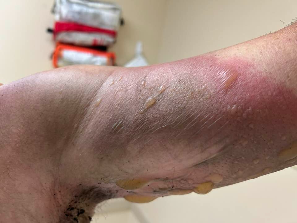 Help support Andy as he recovers from burn injury campaign photo, 6 of 8