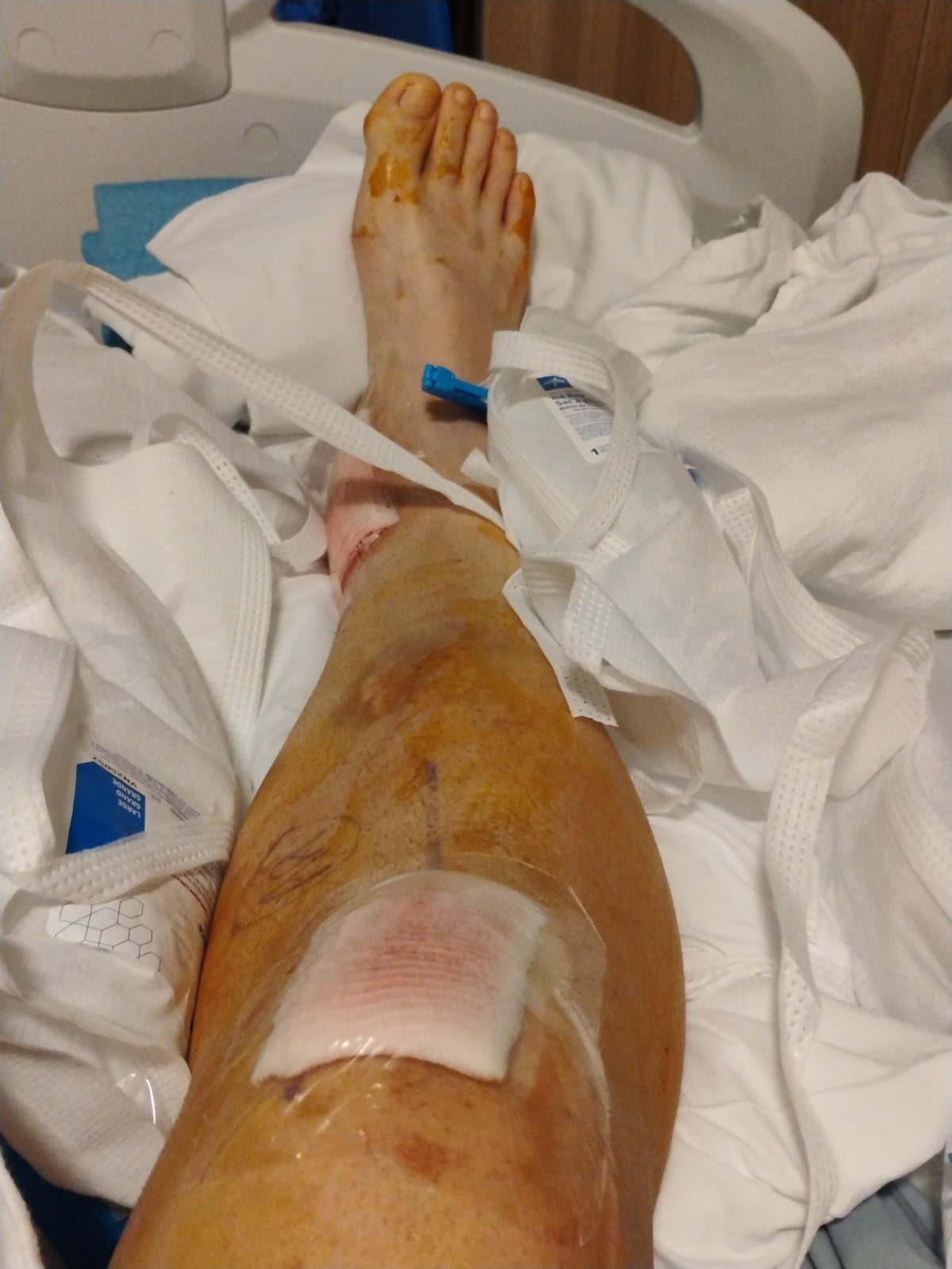 Help Me Recover After a Severe Bone Infection & Surgery campaign photo, 7 of 8