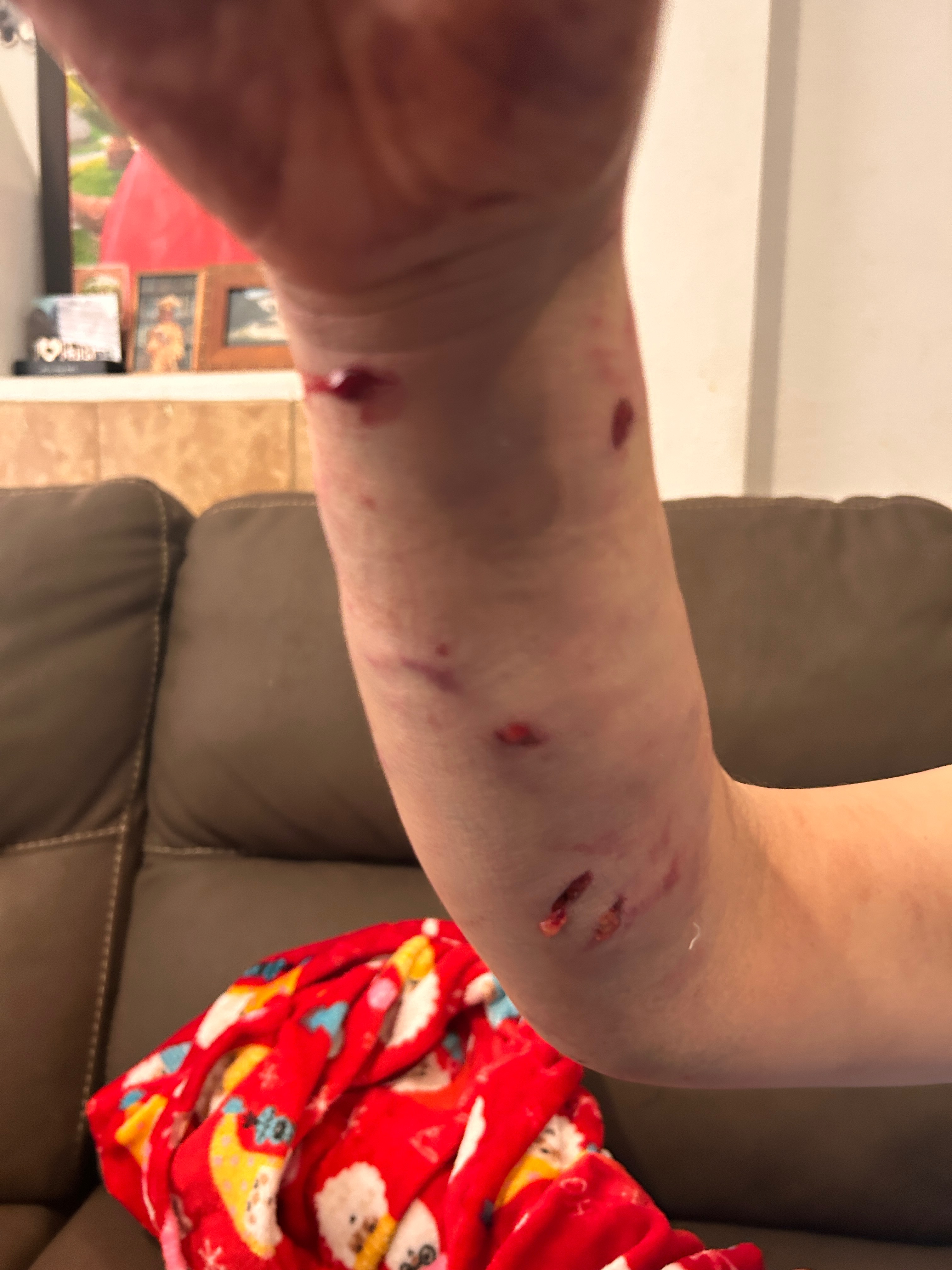Help Teresa Heredia Recover from Dog Attack campaign photo, 2 of 6