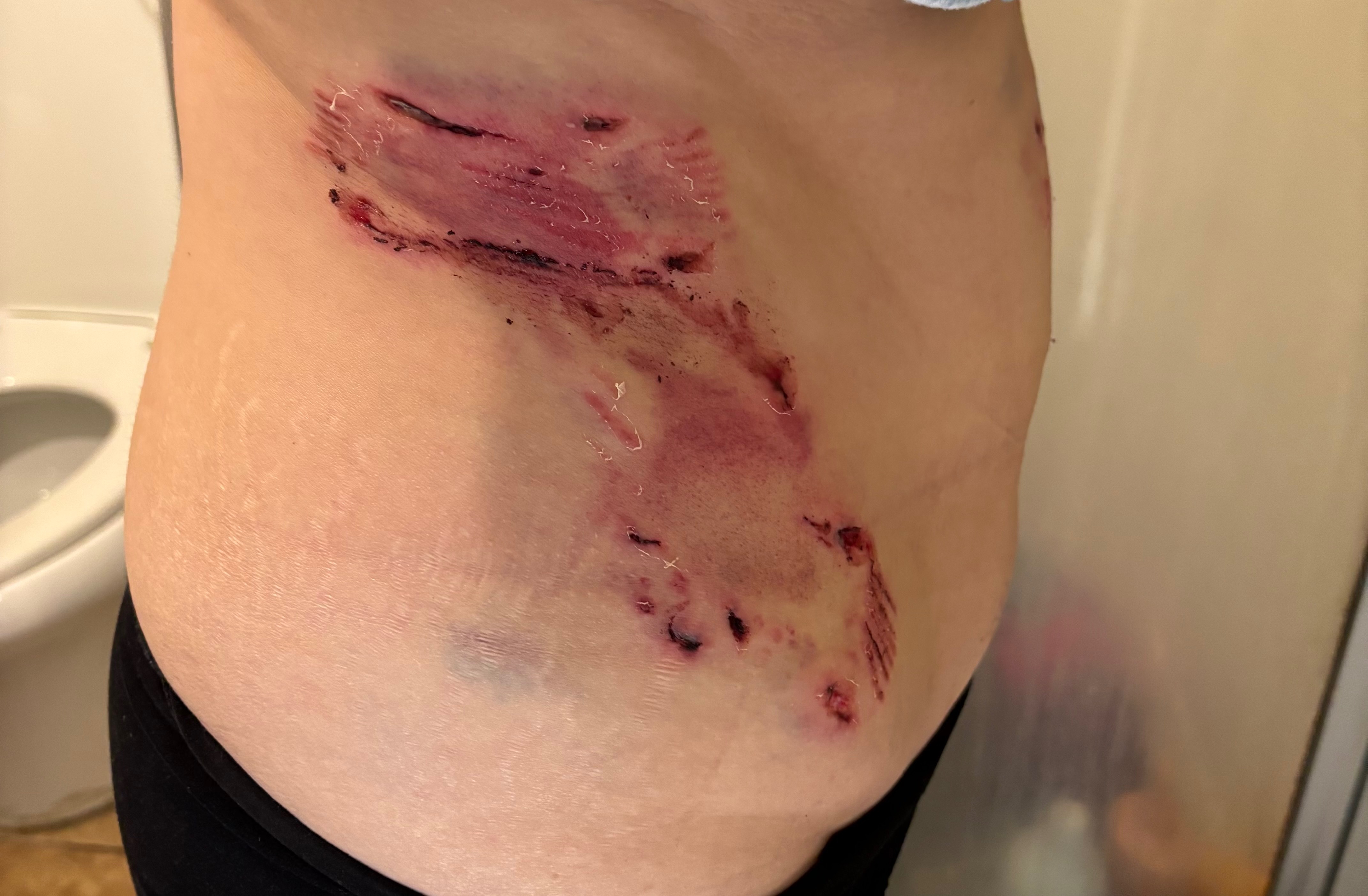 Help Teresa Heredia Recover from Dog Attack campaign photo, 4 of 6
