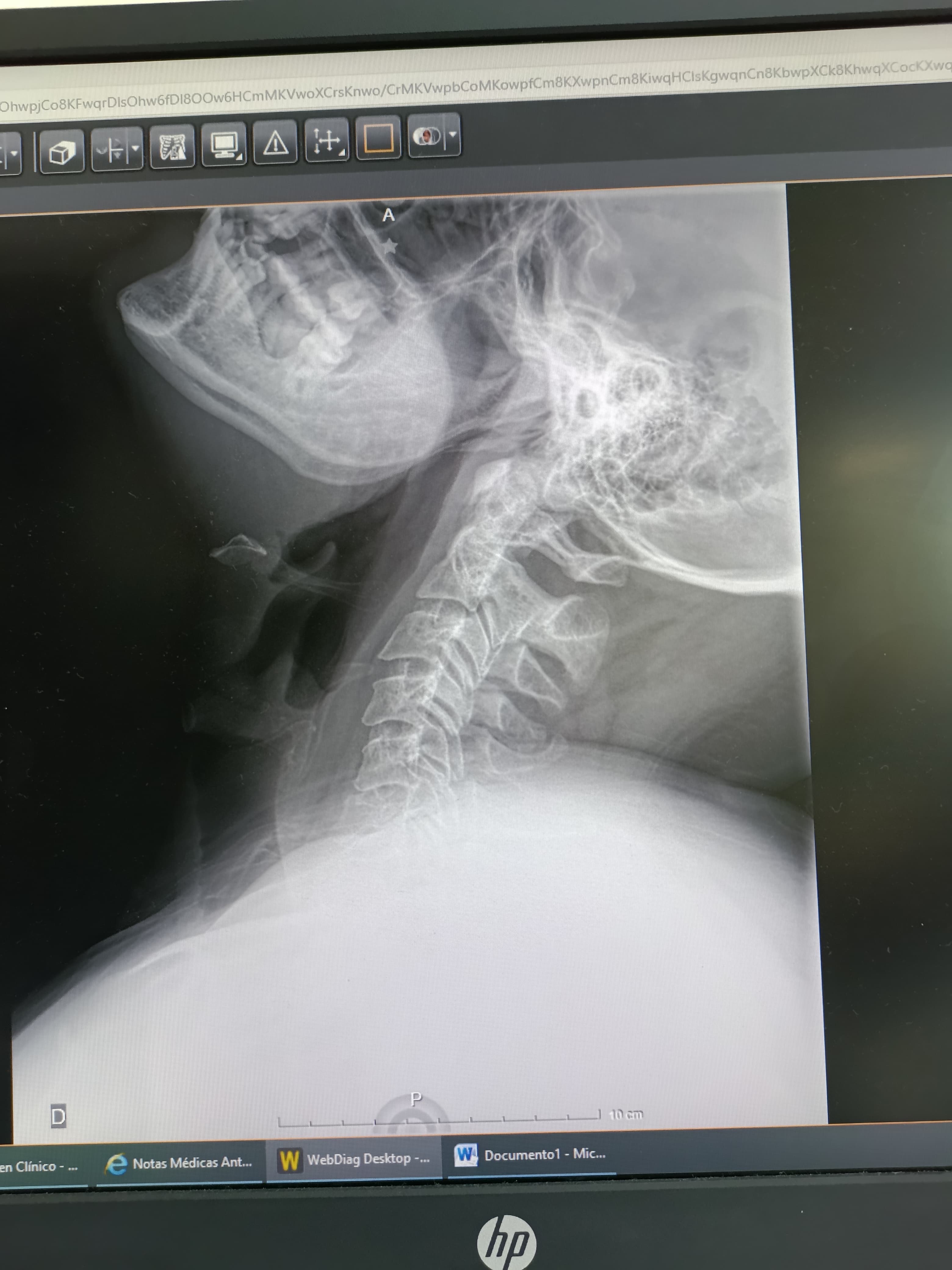 Urgent Help for My Brother’s Surgery in Mexico (C6 Spinal Fr campaign photo, 6 of 8