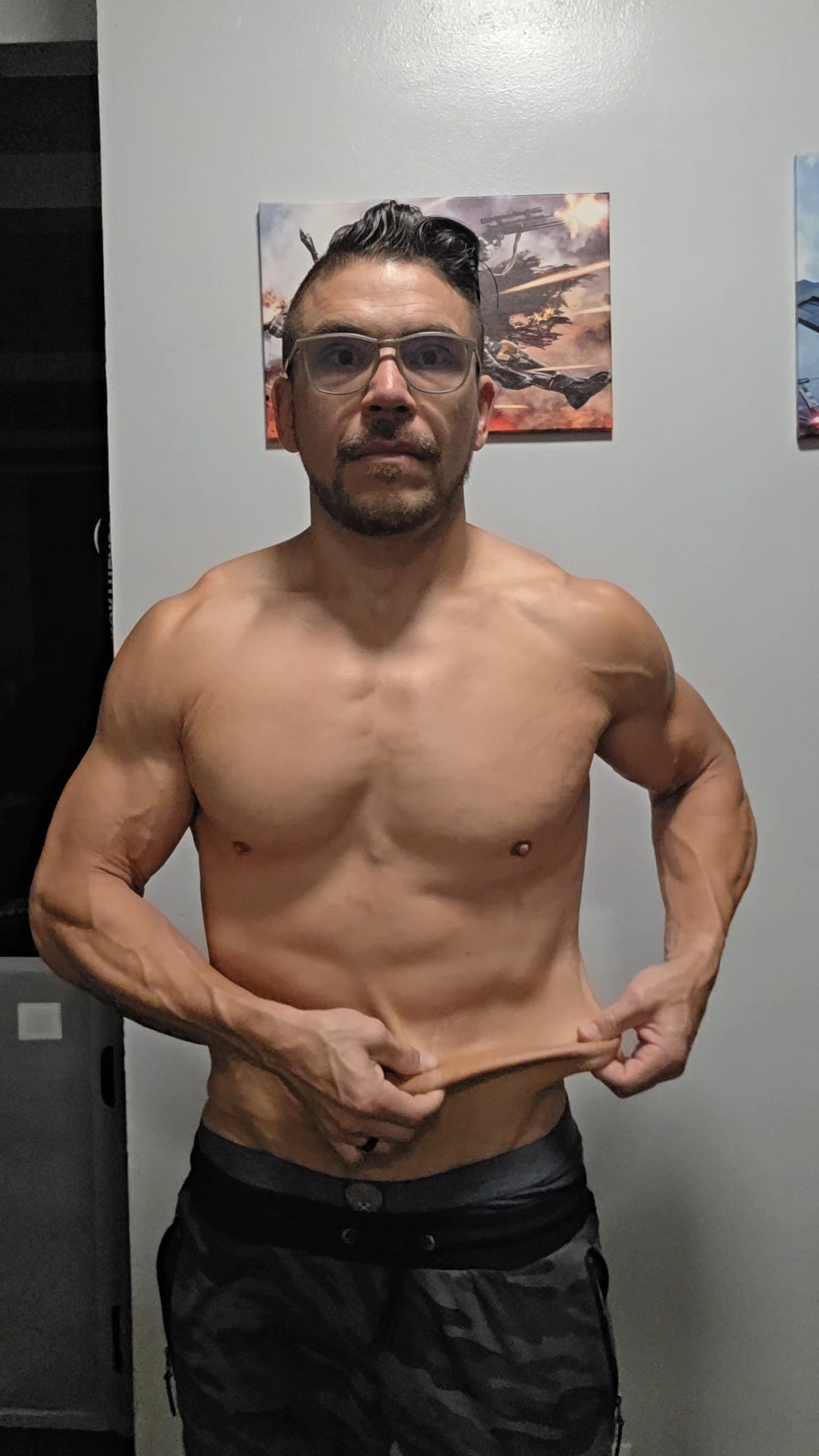 Victor's skin removal surgery campaign photo, 4 of 7