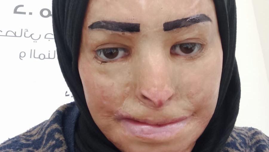 Donate to Transform Hedaya's Life campaign photo, 2 of 6