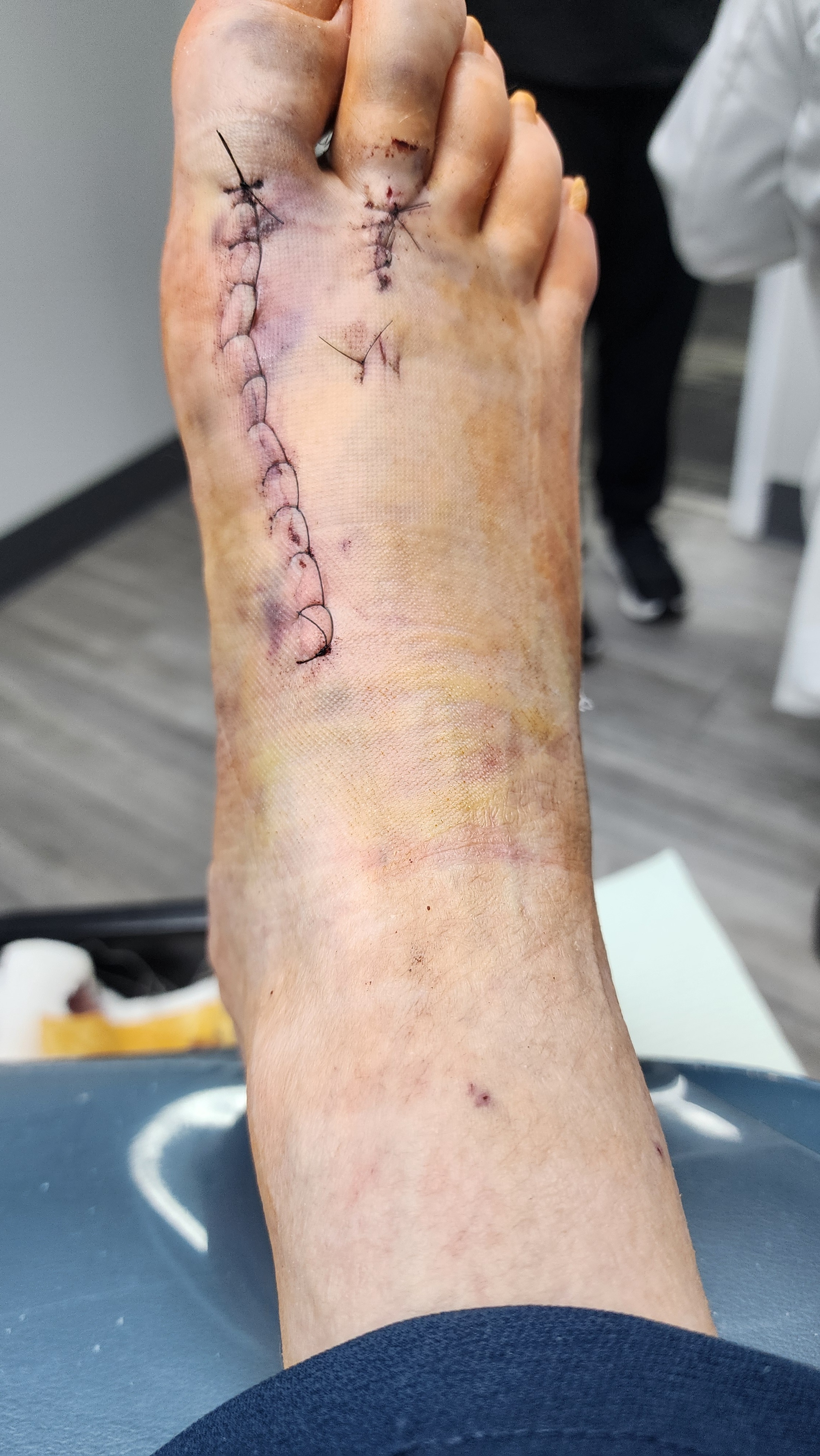 Help support Josh through Heart & Foot Infection Journey campaign photo, 7 of 8