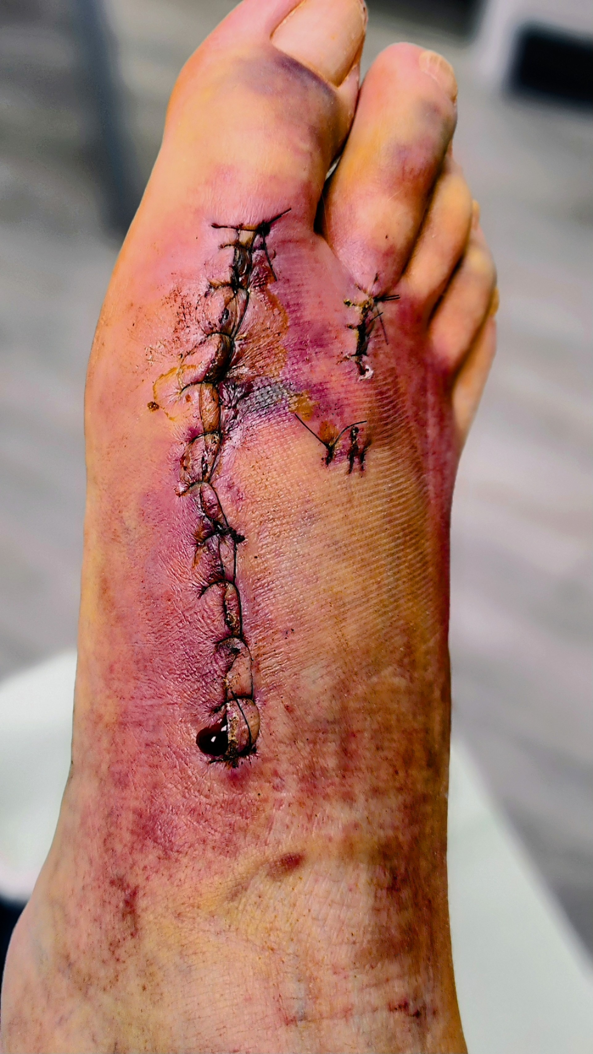 Help support Josh through Heart & Foot Infection Journey campaign photo, 6 of 8