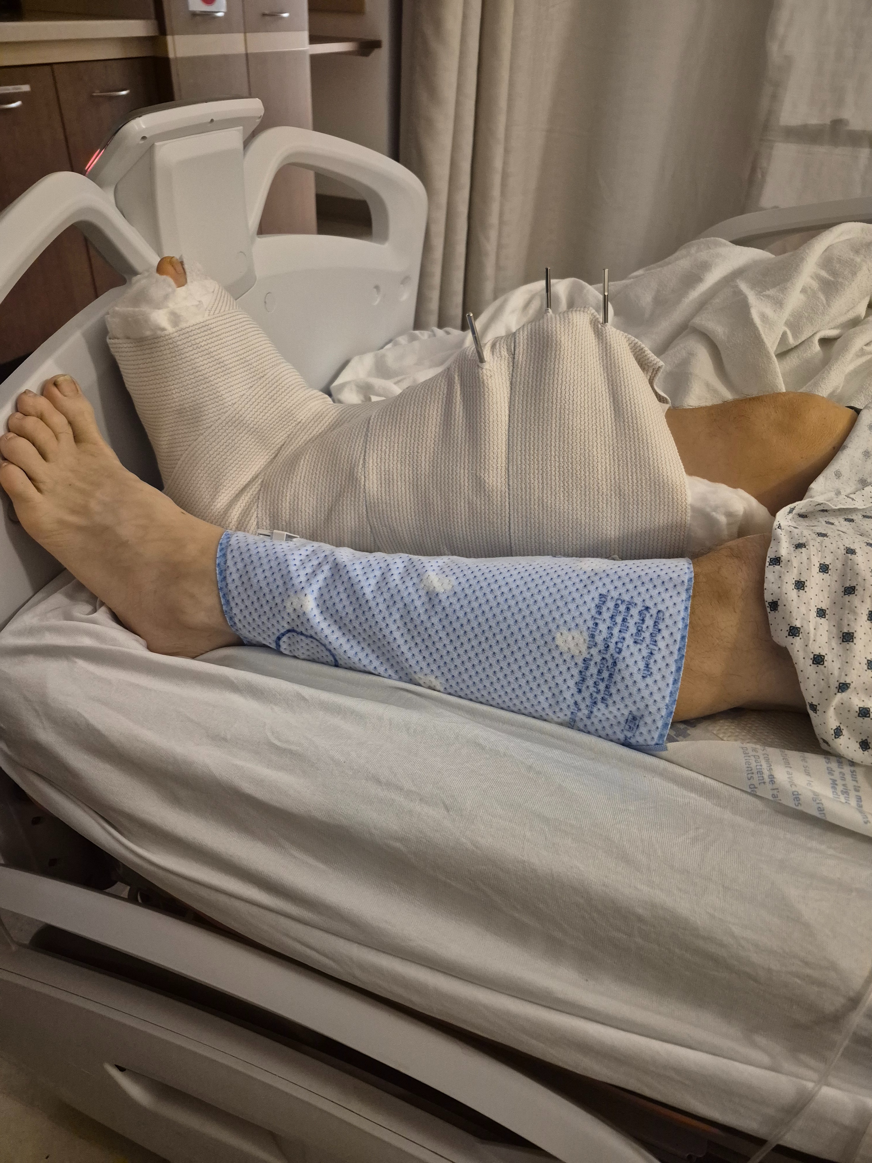 Bob's recovery fund for broken Tibia and Fibula campaign photo, 2 of 5