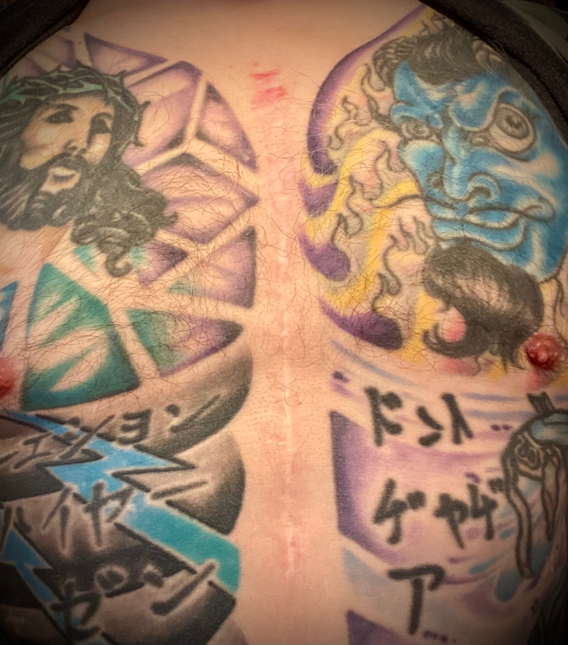 Help Remove Painful Sternum Wires campaign photo, 7 of 8