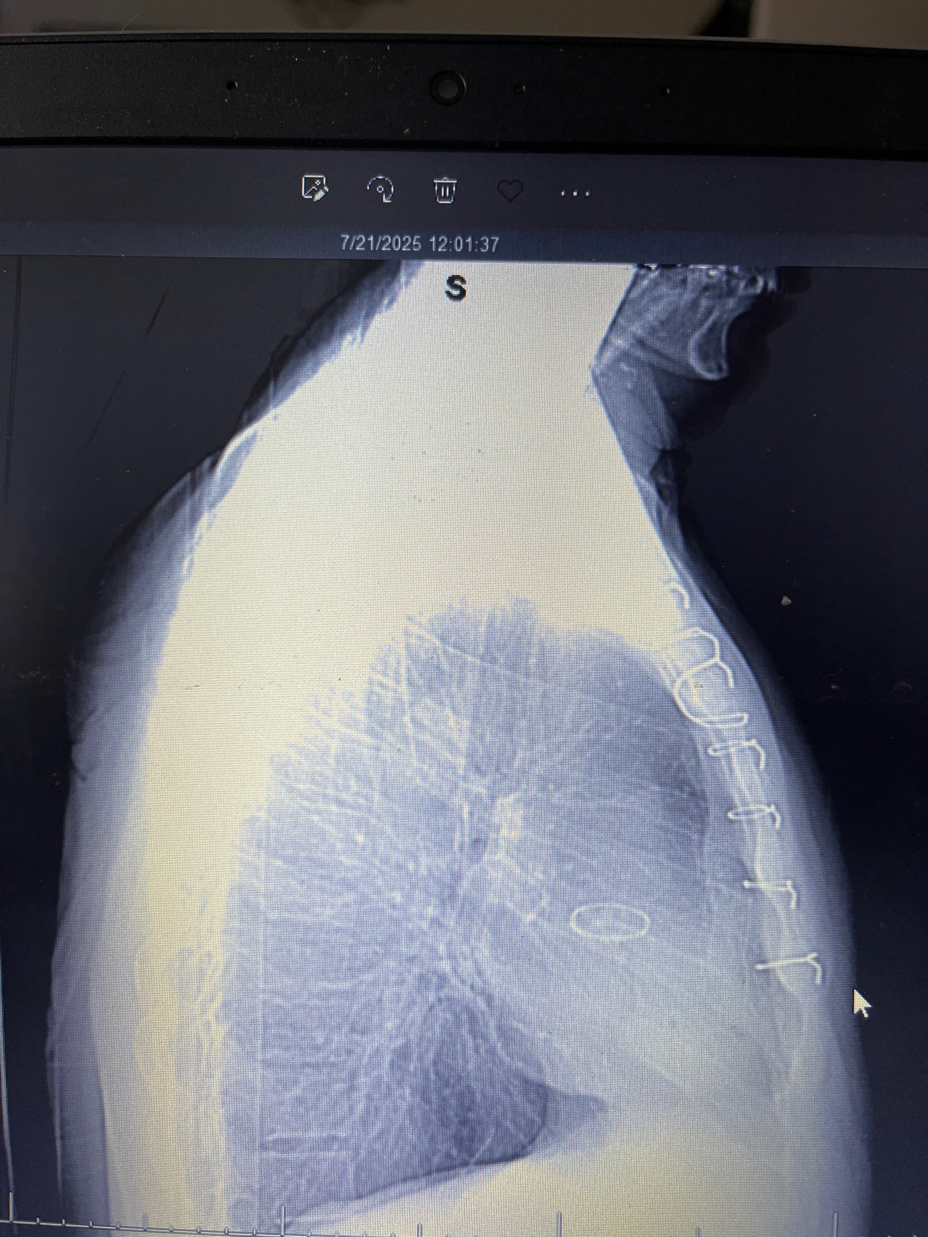 Help Remove Painful Sternum Wires campaign photo, 6 of 8