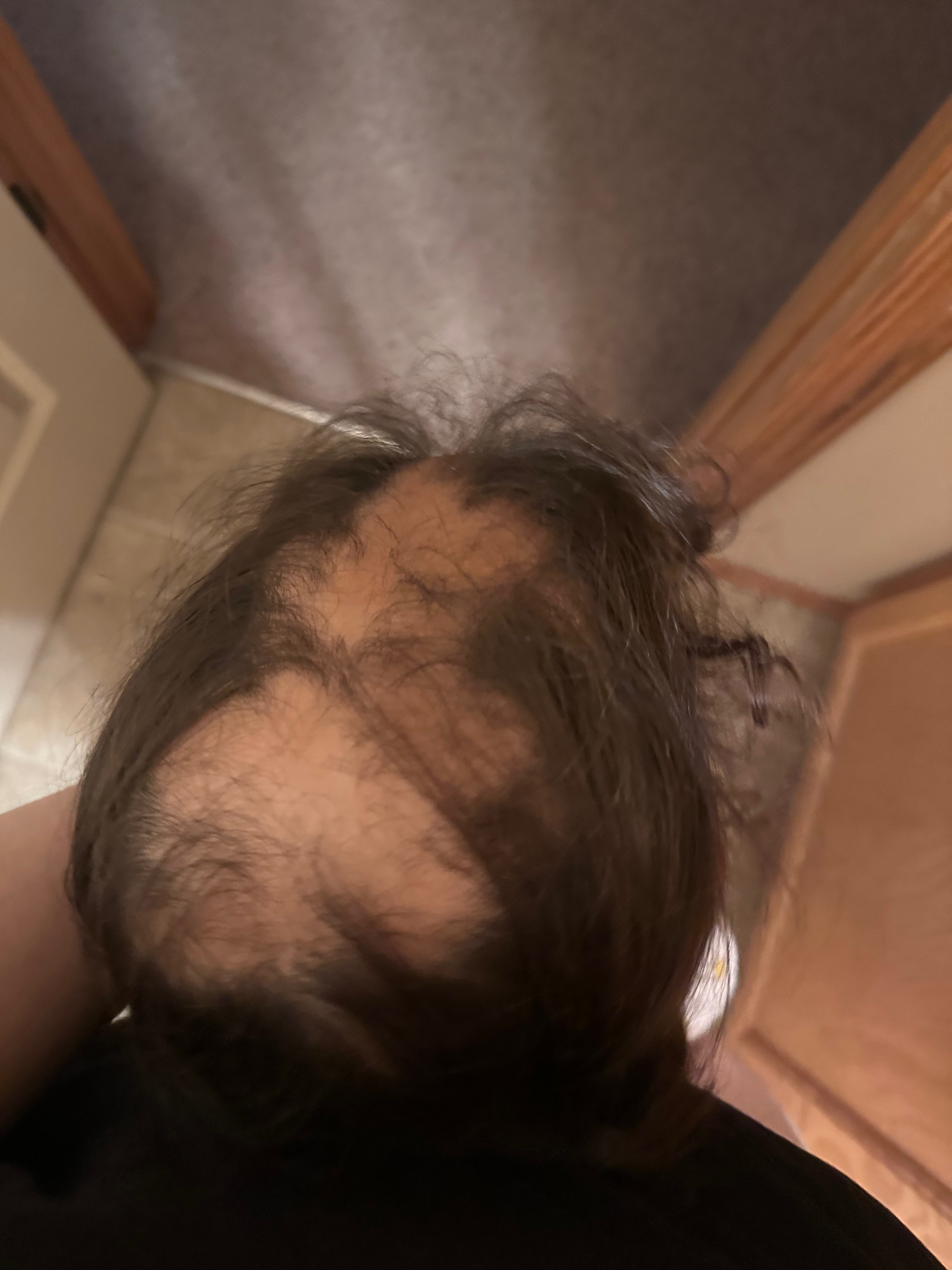 Help support Gianna’s journey with Alopecia Areata campaign photo, 6 of 7