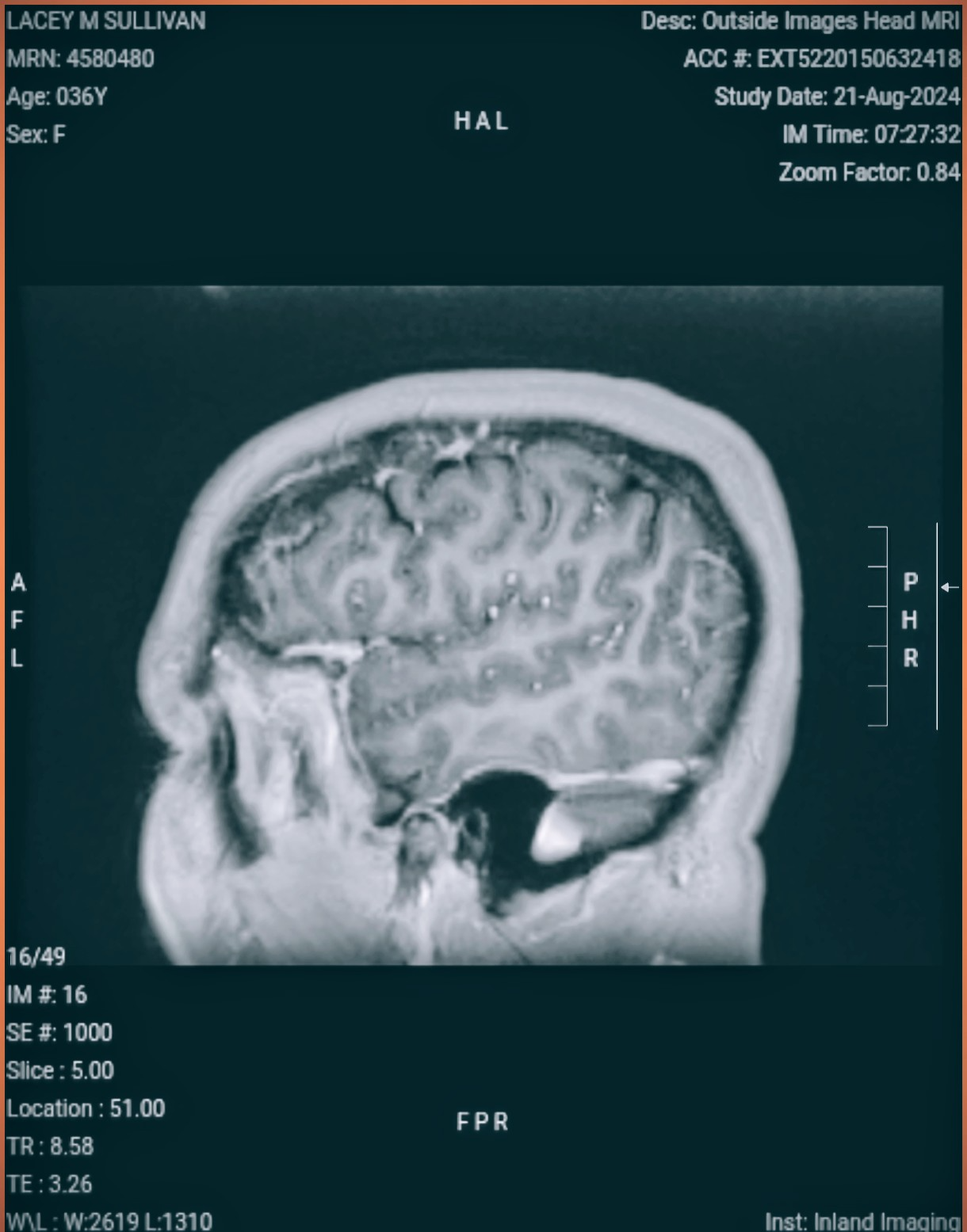 Support life changing brain surgery for Lacey. campaign photo, 5 of 8