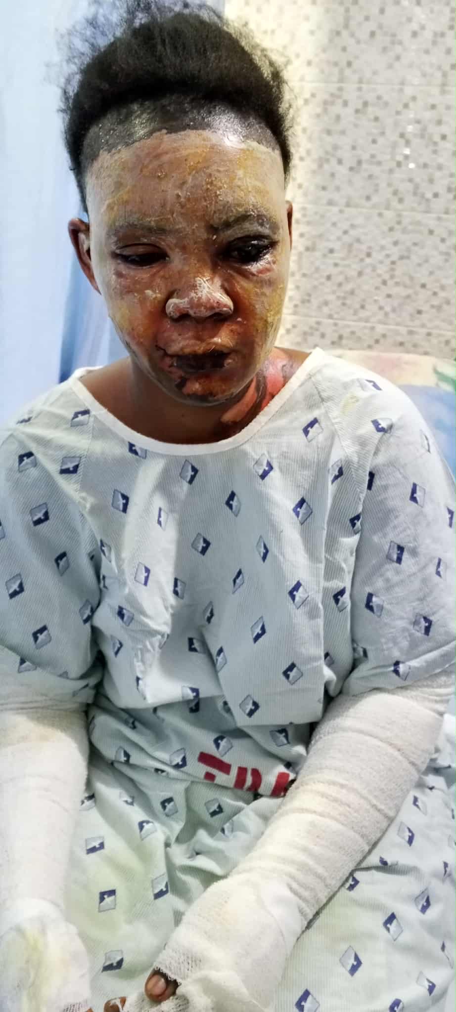 Help Josephine Heal After Burn Accident campaign photo, 5 of 6