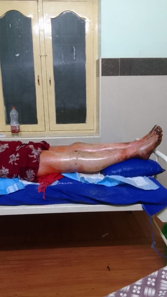 Help My Mom, Rukmini Recover From Devastating Burn Accident campaign photo, 2 of 4