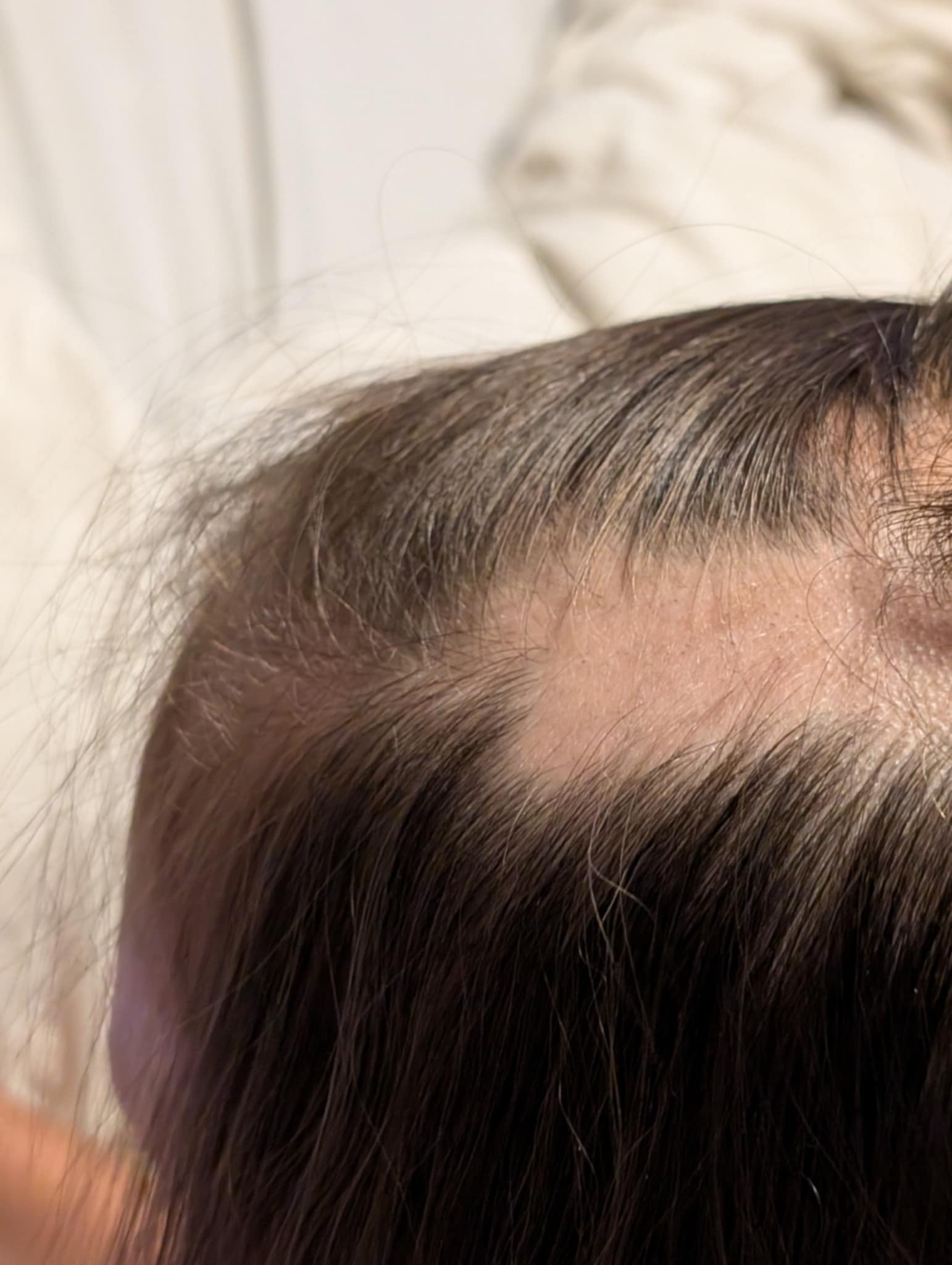 Help My Niece Feel Confident Again After Alopecia Diagnosis campaign photo, 6 of 7