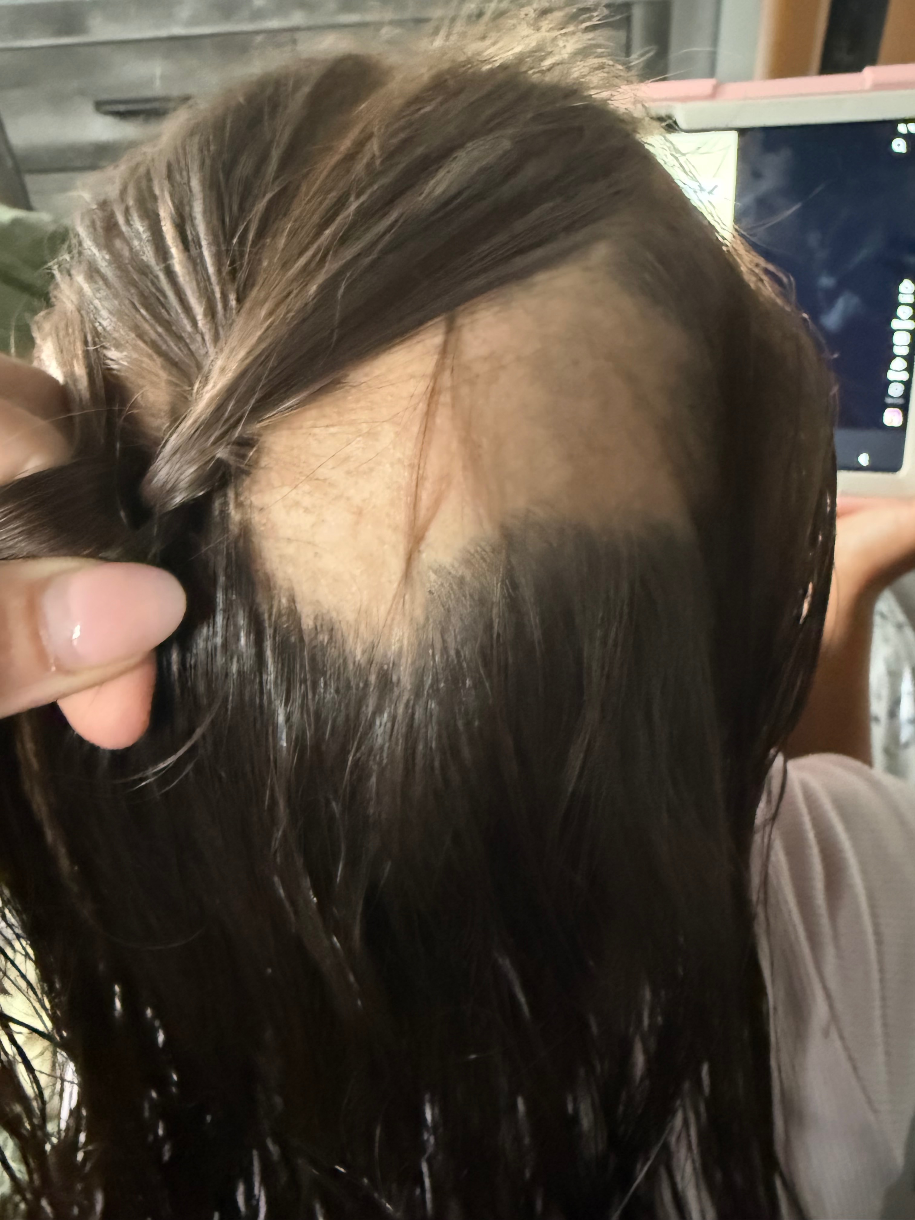 Help My Niece Feel Confident Again After Alopecia Diagnosis campaign photo, 4 of 7