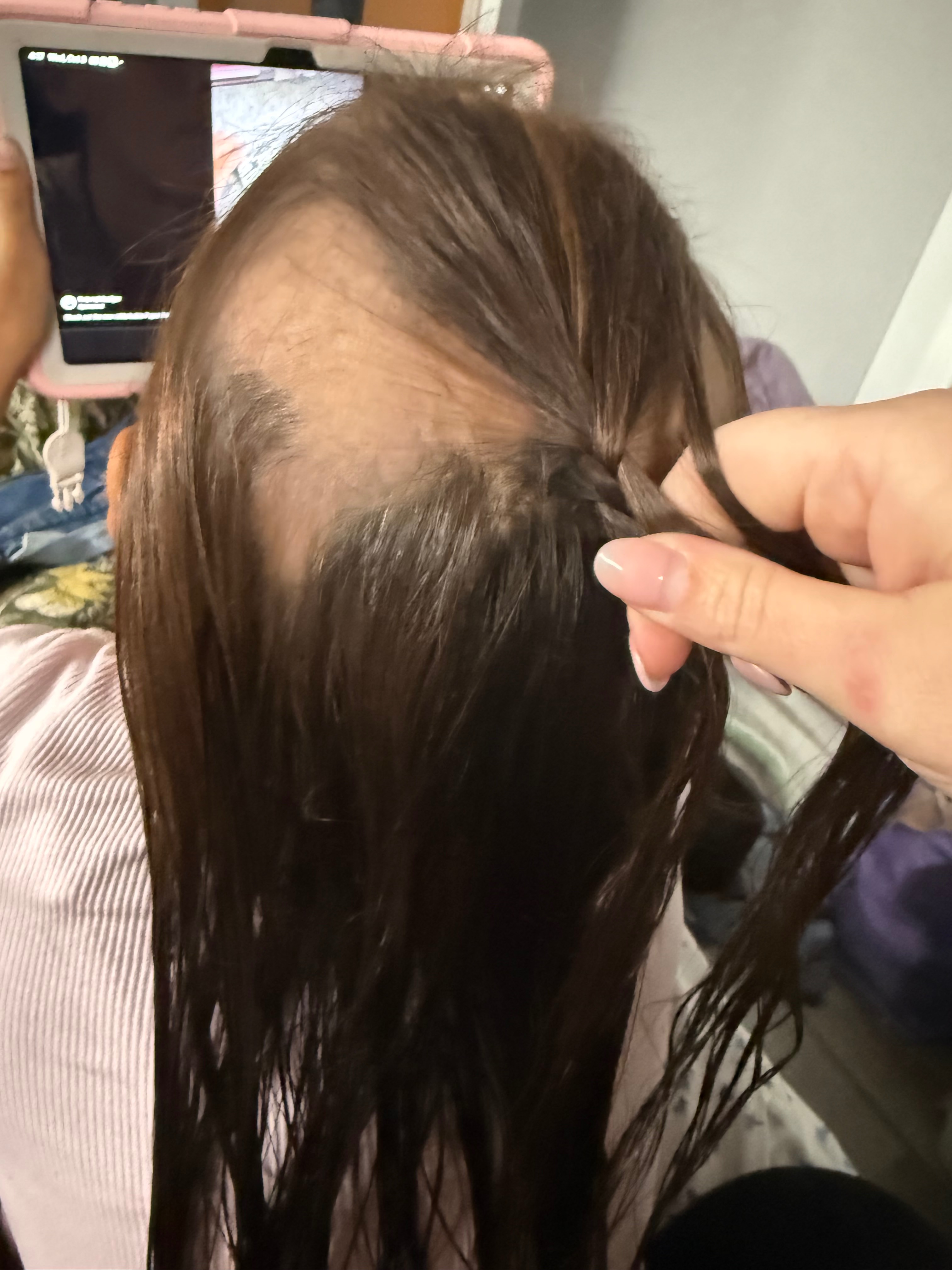 Help My Niece Feel Confident Again After Alopecia Diagnosis campaign photo, 2 of 7