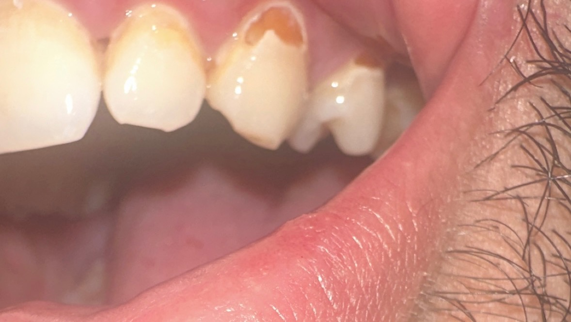 Estoy sufriendo por un diente dañado y necesito ayuda urgent photo