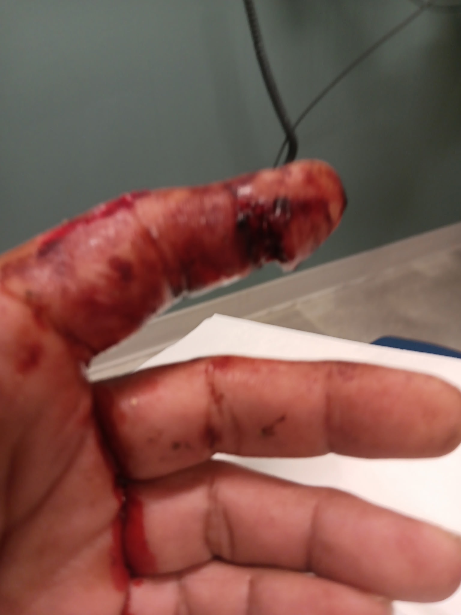Brutal XL Pit Bull attack: Help my Dad and Brook heal. campaign photo, 2 of 8