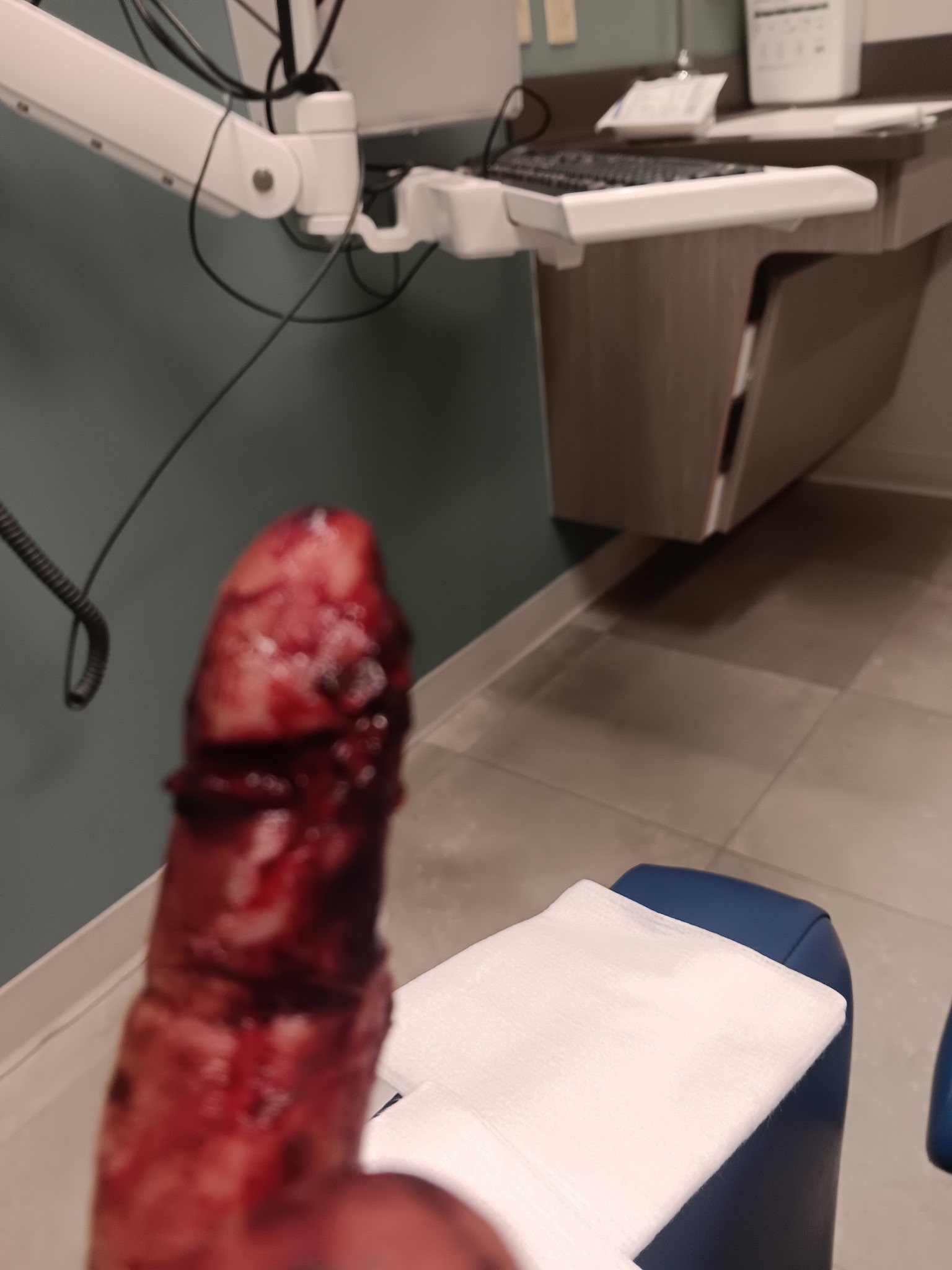 Brutal XL Pit Bull attack: Help my Dad and Brook heal. campaign photo, 7 of 8