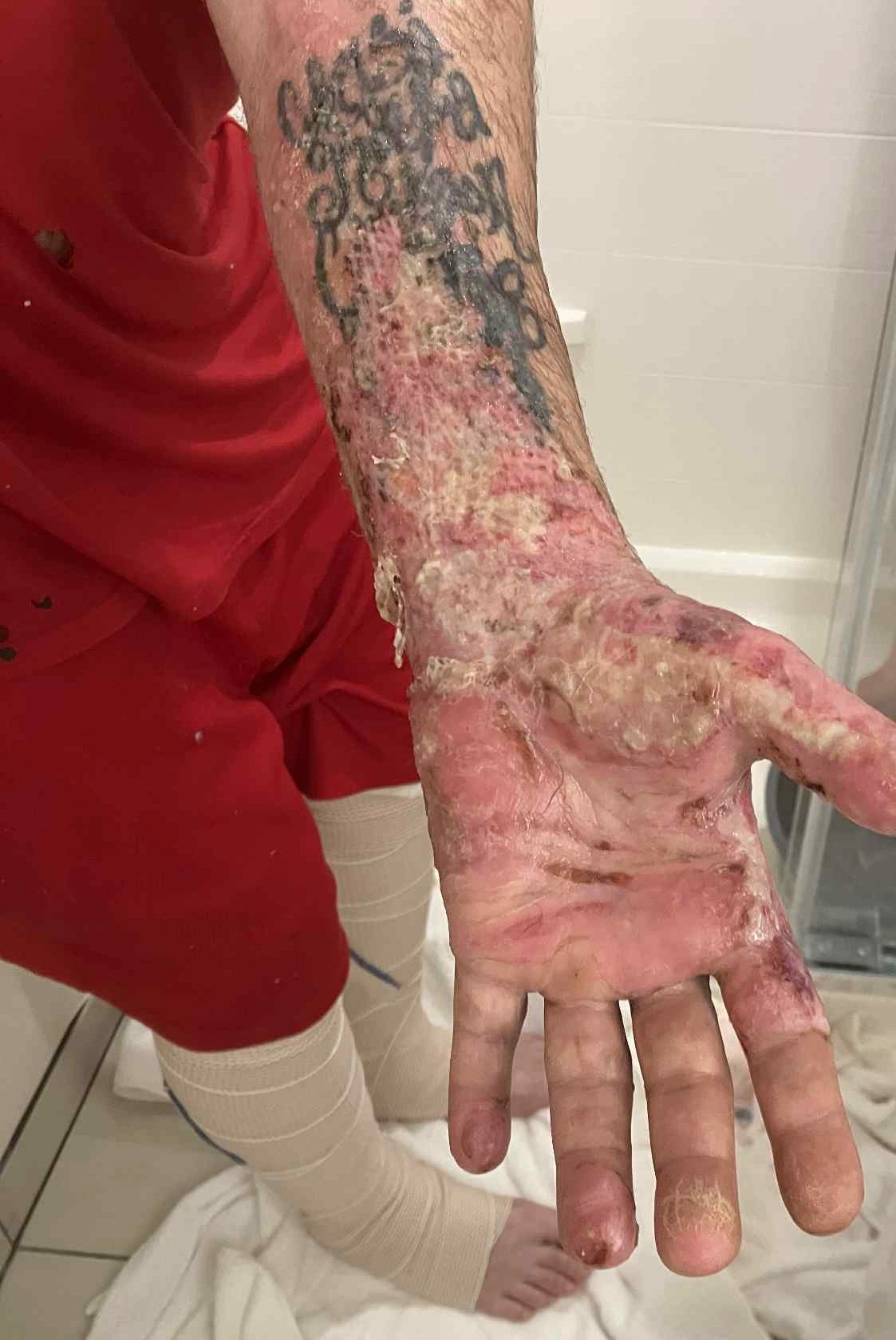Support Kent's Recovery- House Fire Severe Burns campaign photo, 2 of 8