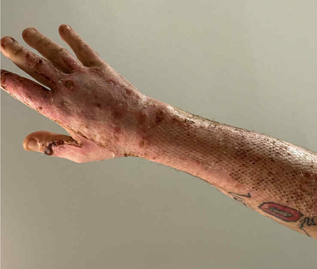 Support Kent's Recovery- House Fire Severe Burns campaign photo, 5 of 8