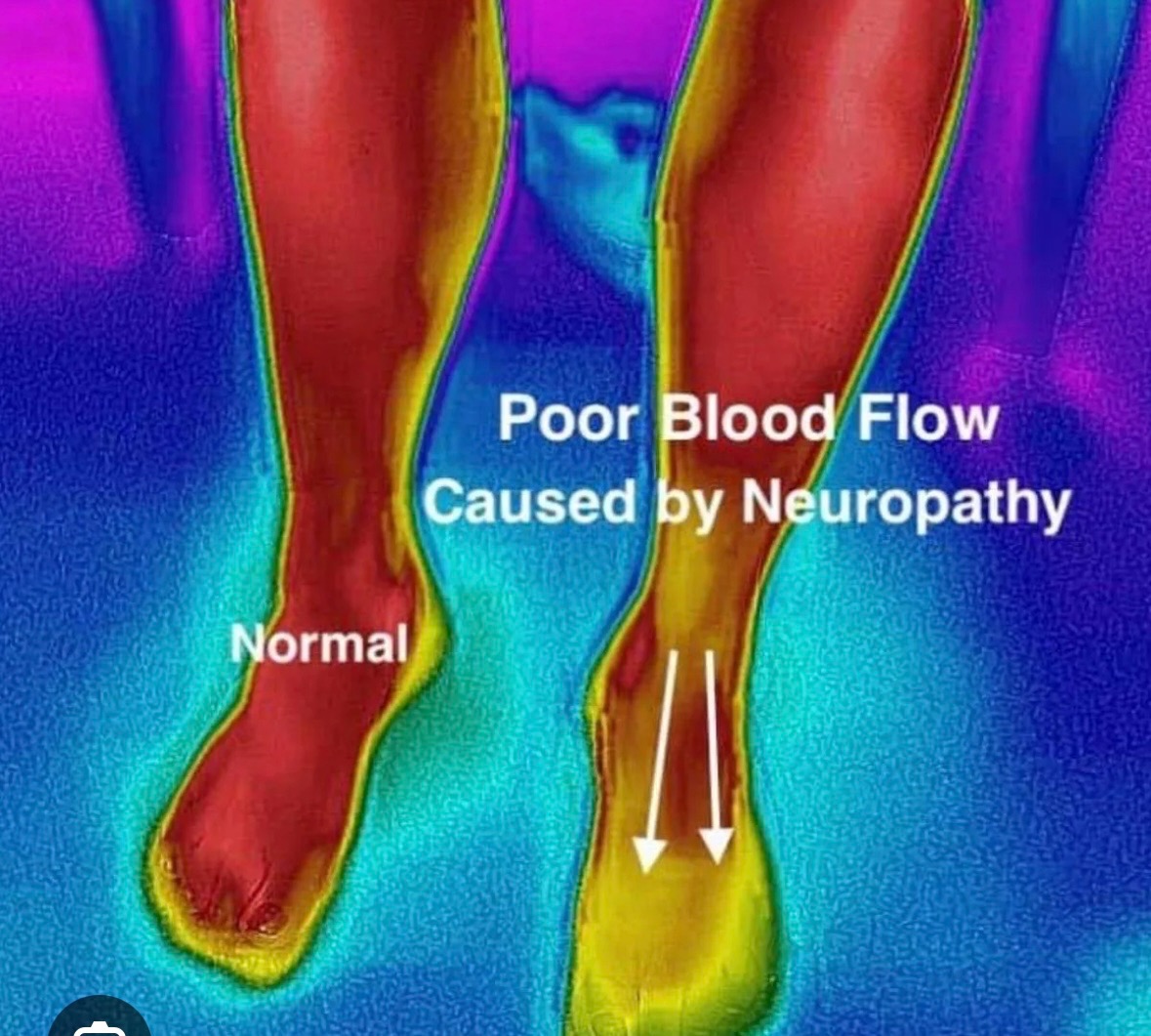 Urgent Help Needed for Neuropathy Treatment campaign photo, 5 of 6