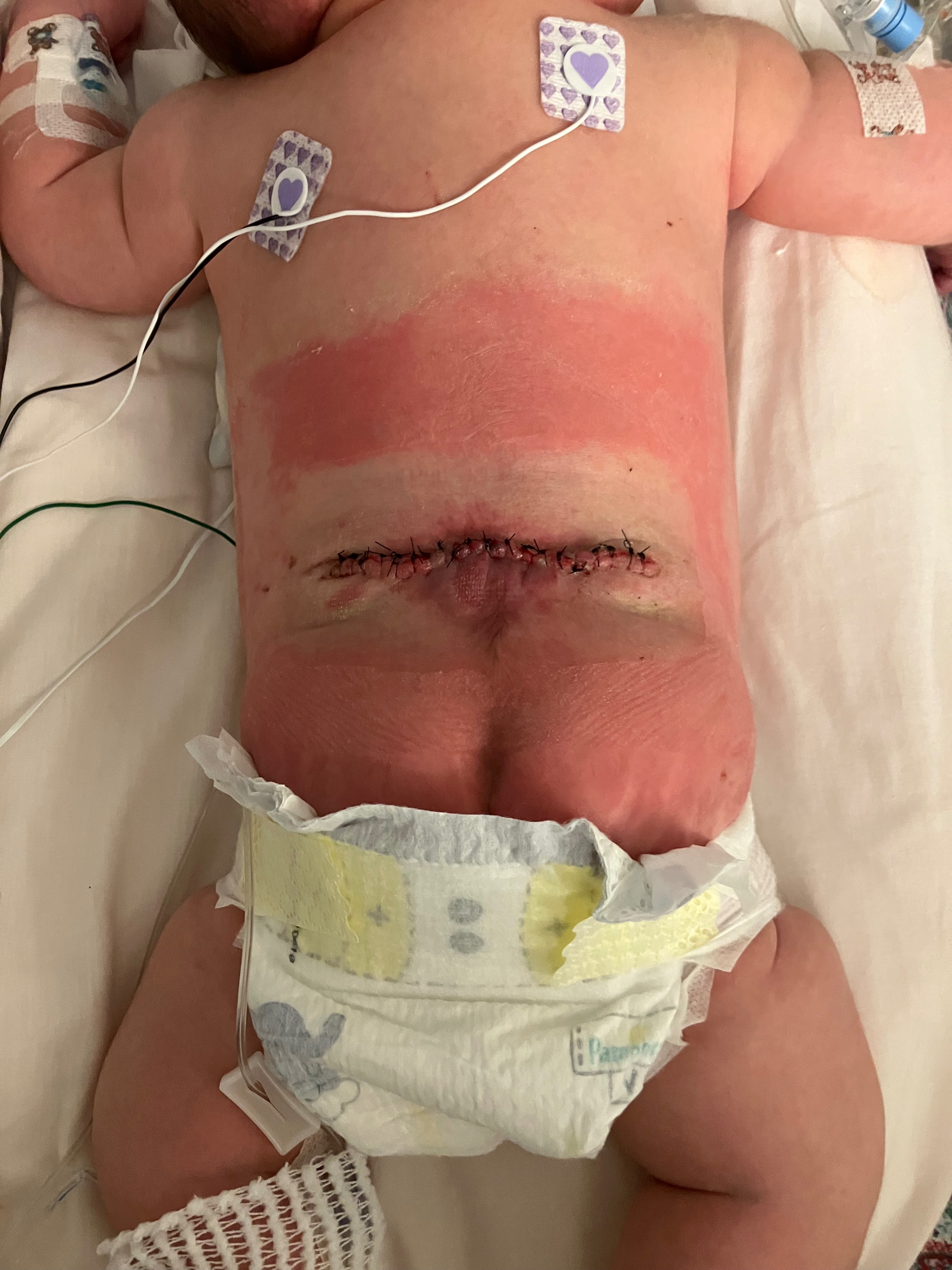Help Support Baby Jemimah’s Journey With Spina Bifida campaign photo, 2 of 8