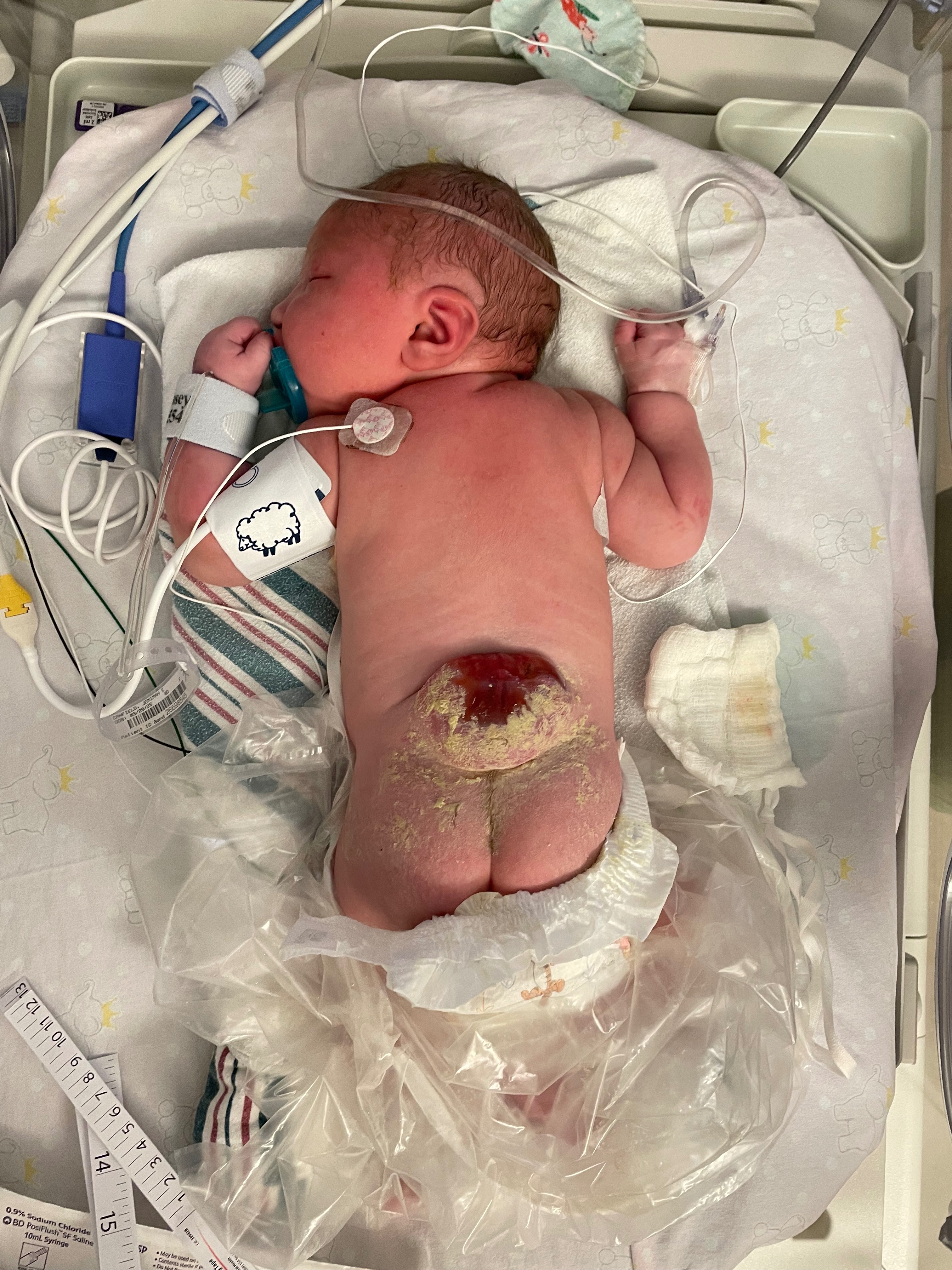 Help Support Baby Jemimah’s Journey With Spina Bifida campaign photo, 6 of 8