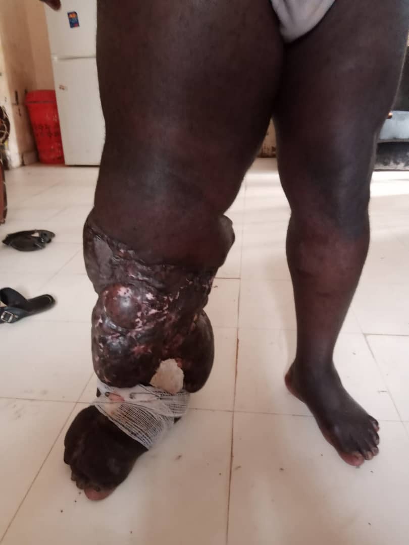 Help Momodou Pierra with overseas treatment. campaign photo, 2 of 4