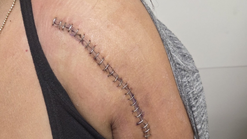 Support Sandra's Recovery from Shoulder Surgery photo