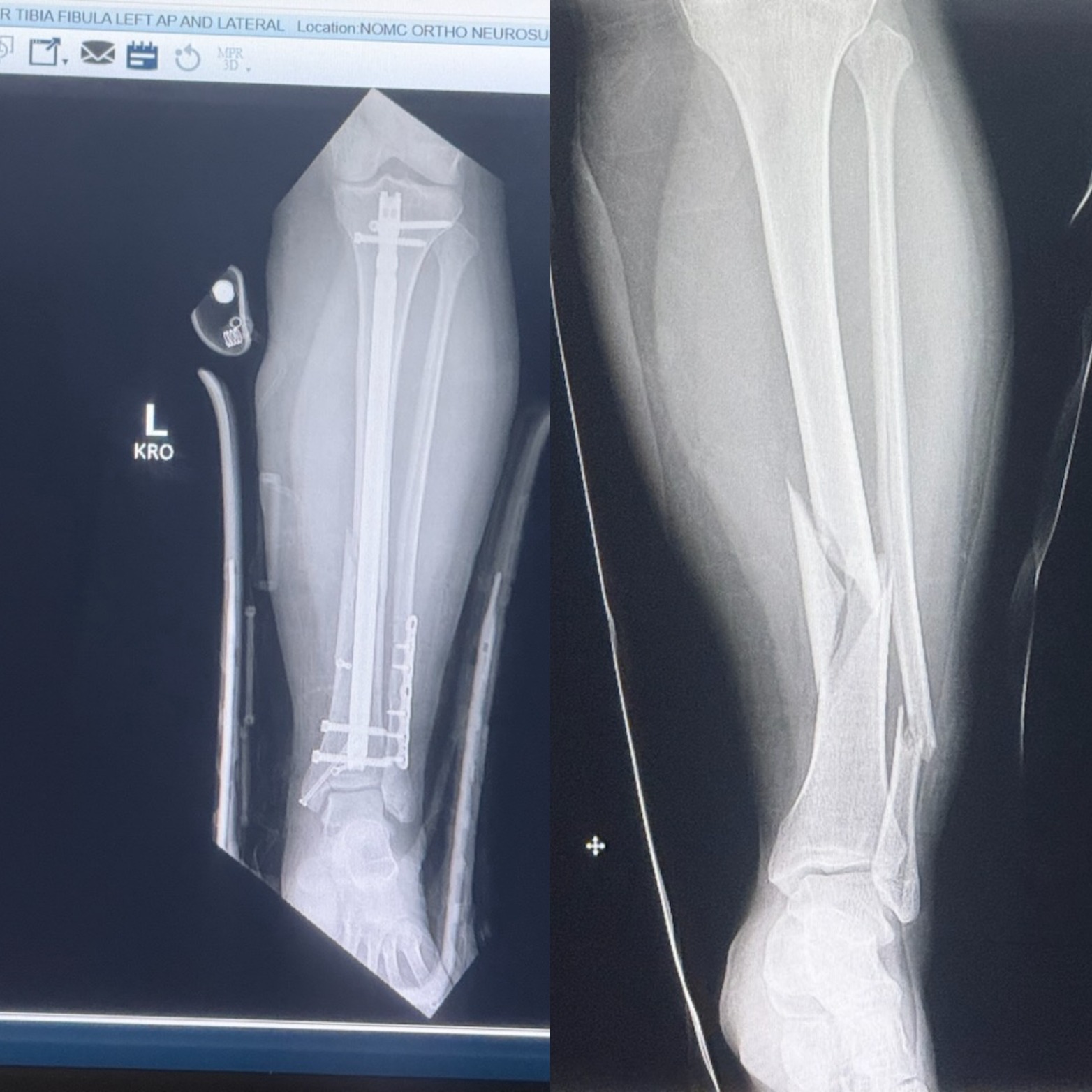 A single mom with a broken leg needs help campaign photo, 2 of 4