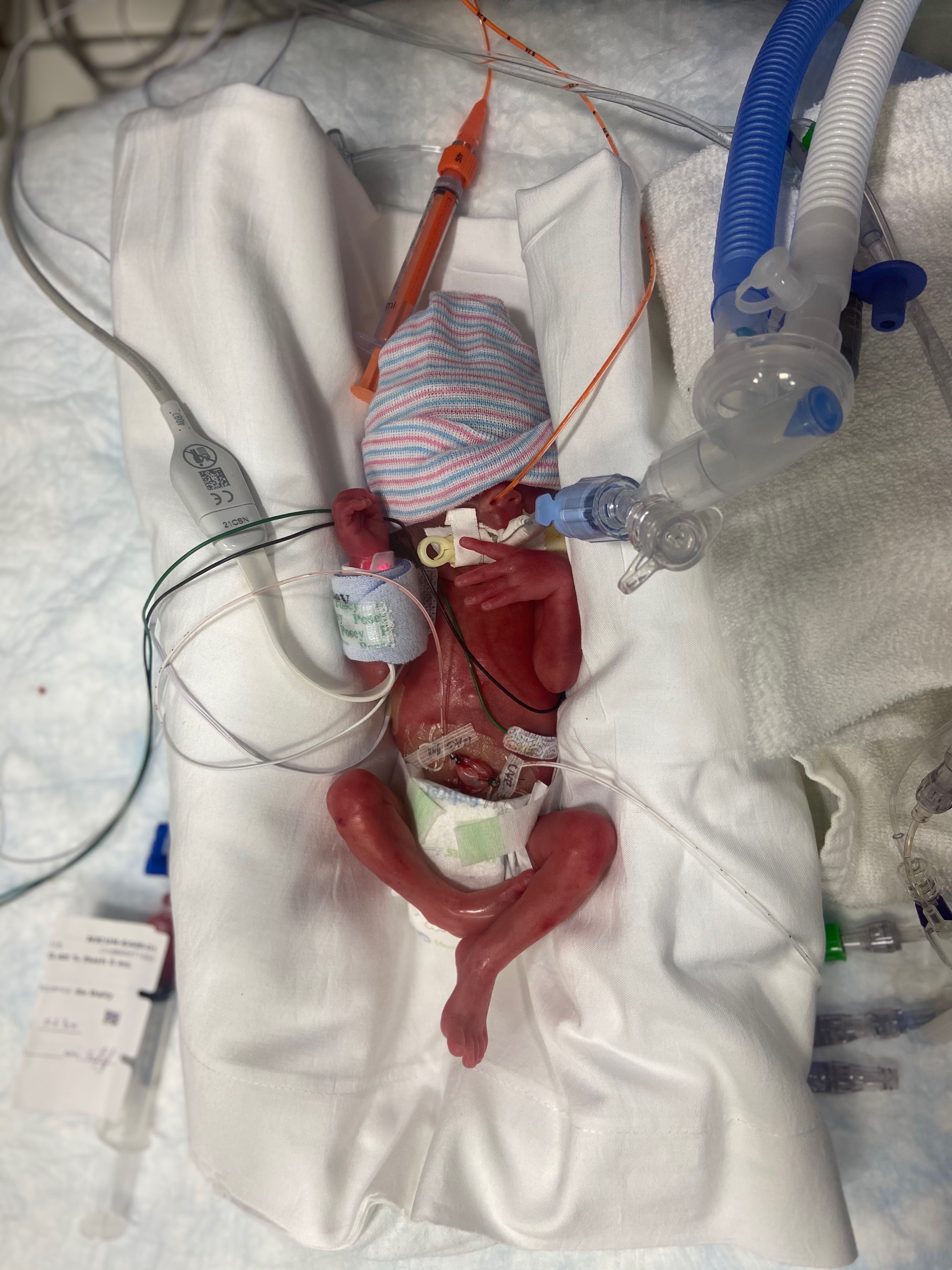 Help Our Miracle Girl, Gwendlyn Rose, Walk Freely campaign photo, 6 of 8