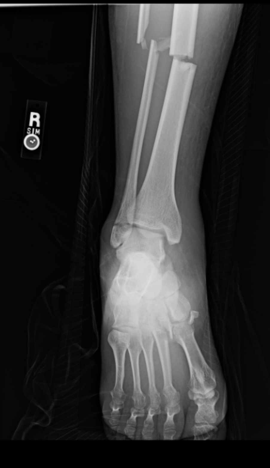 Aid Bryce's(Shadow's) Recovery After a Devastating Accident campaign photo, 2 of 8