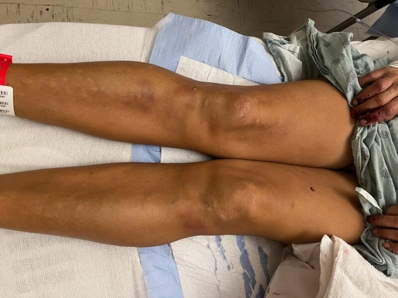 Support Our Sister's Recovery After Dog Attack campaign photo, 4 of 5