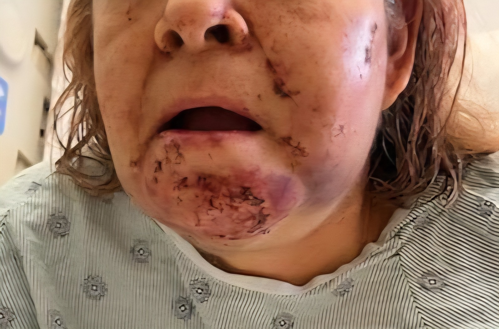 Support Our Sister's Recovery After Dog Attack campaign photo, 2 of 5