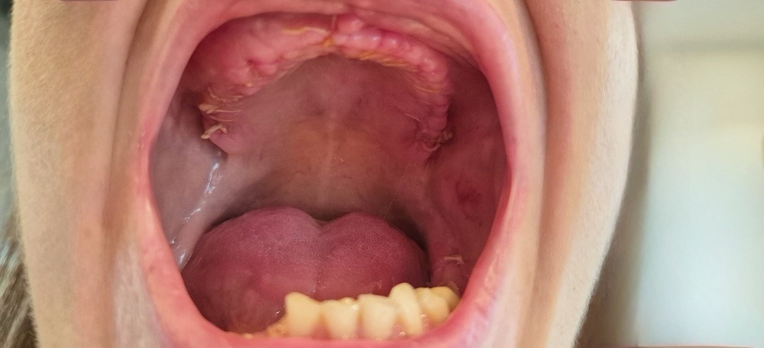 Assistance with implant  placement after bone grafting campaign photo, 4 of 8