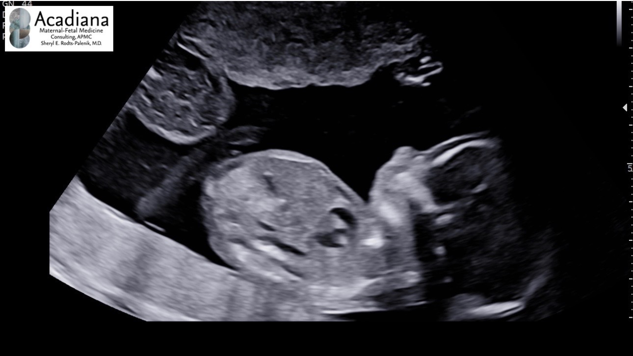 Single Pregnant Mama with TRAP Syndrome needs help. campaign photo, 5 of 6
