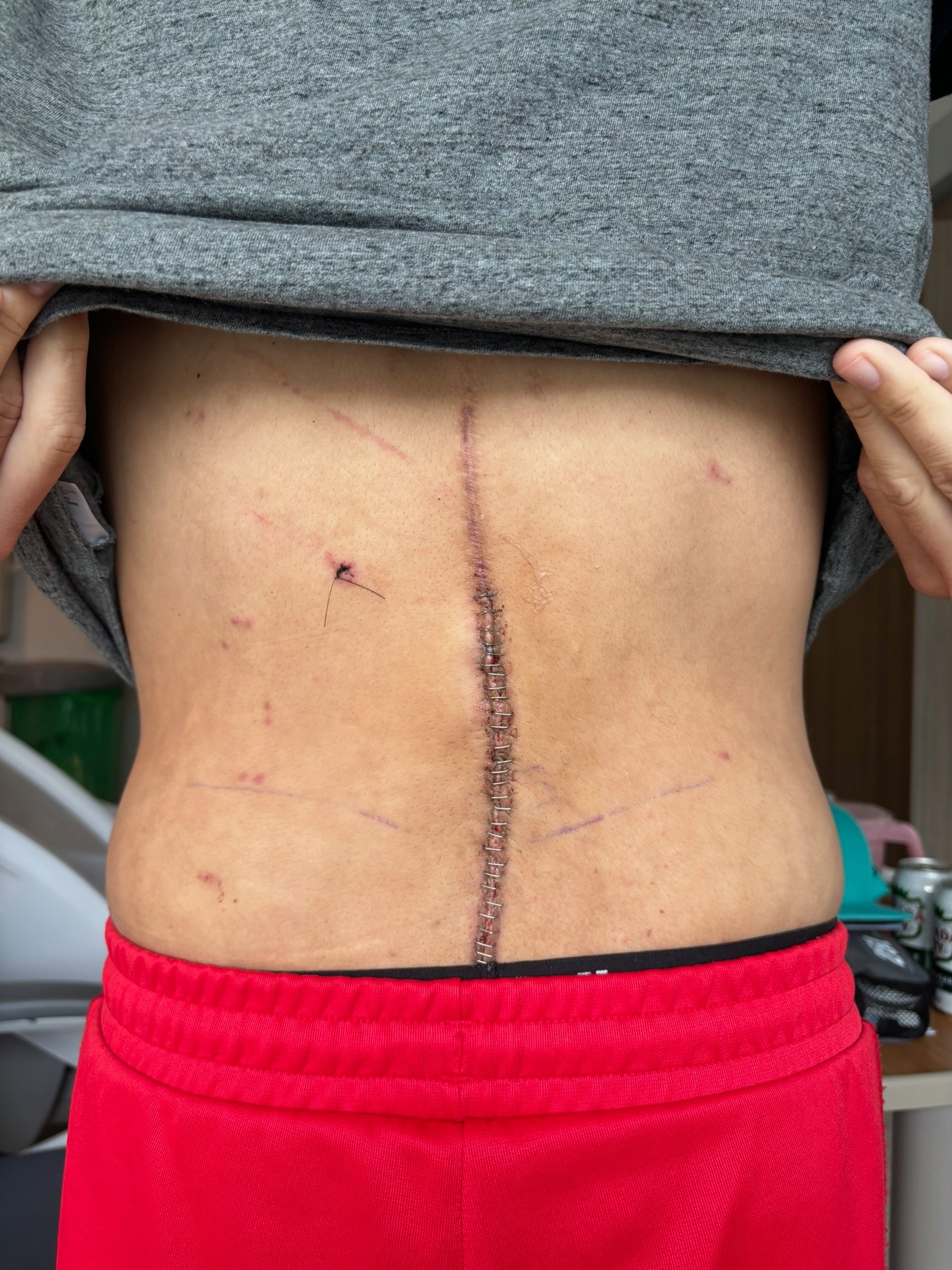 Help Sam Recover After Multiple Surgeries and Hardship campaign photo, 4 of 8