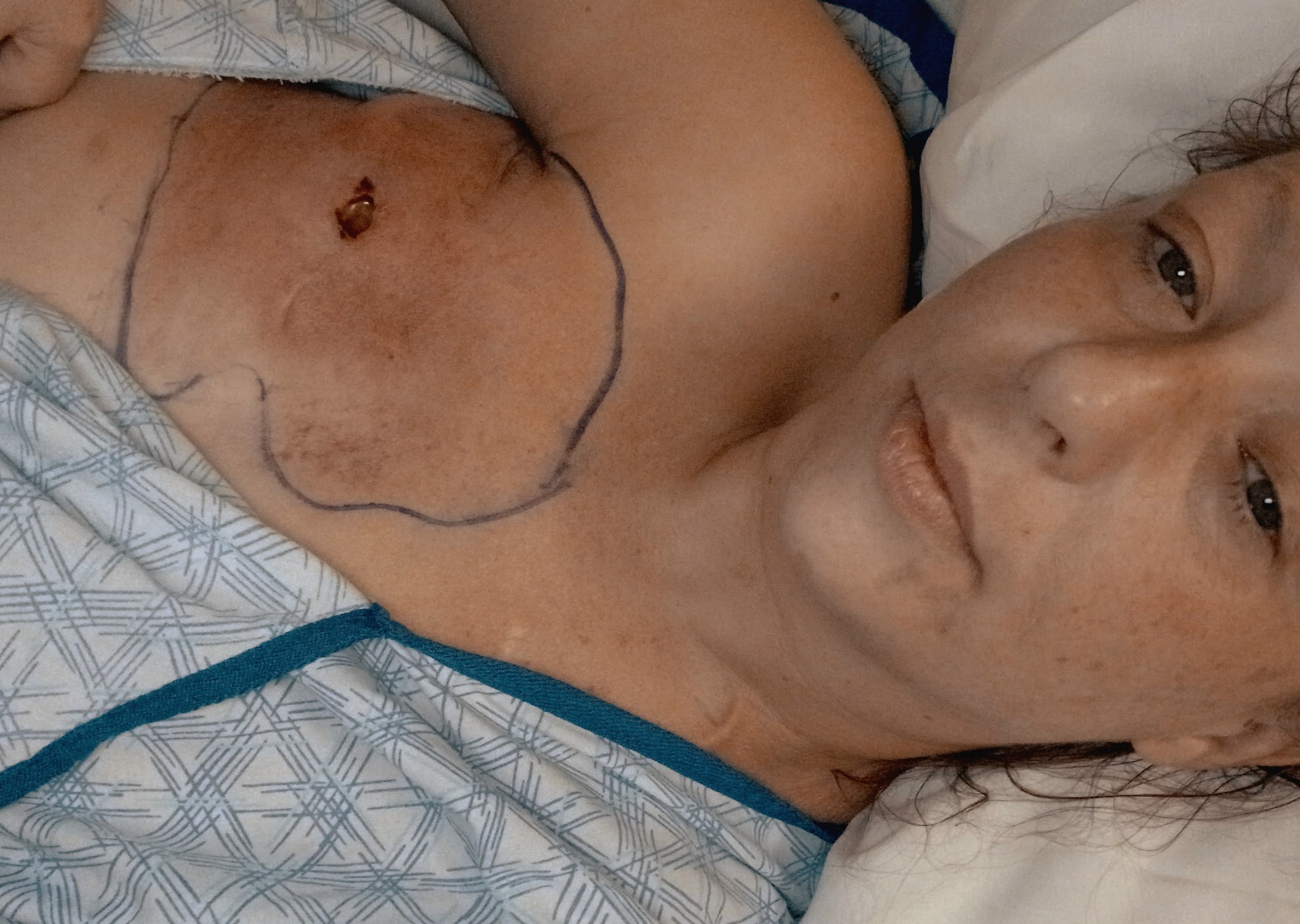 Jesse's 4th Breast Cancer Surgery campaign photo, 7 of 8