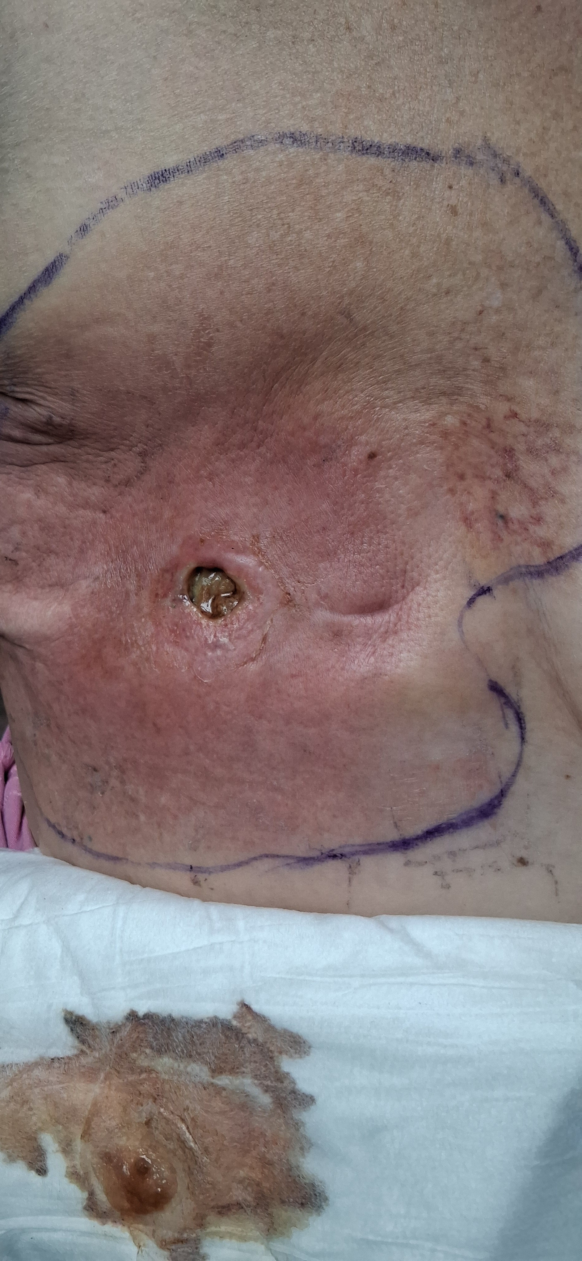 Jesse's 4th Breast Cancer Surgery campaign photo, 5 of 8