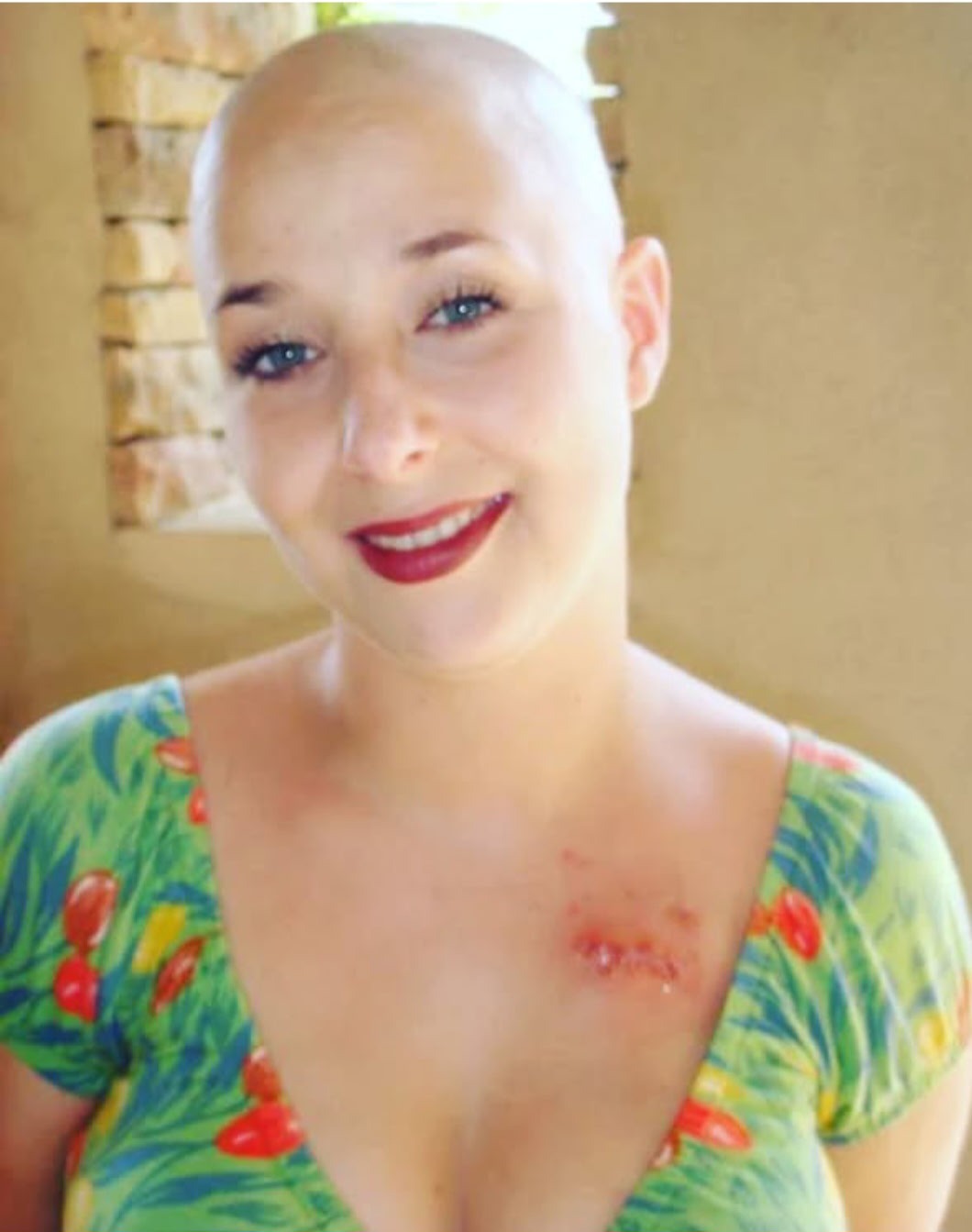 Jesse's 4th Breast Cancer Surgery campaign photo, 4 of 8