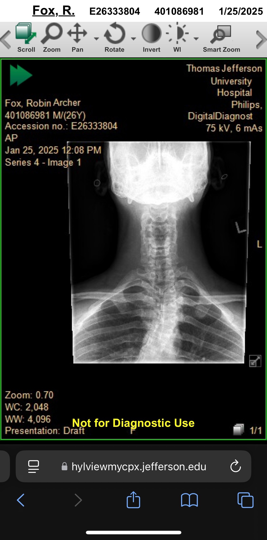 Help Robin Heal: Supporting Neck and Spine Surgery Recovery campaign photo, 2 of 6