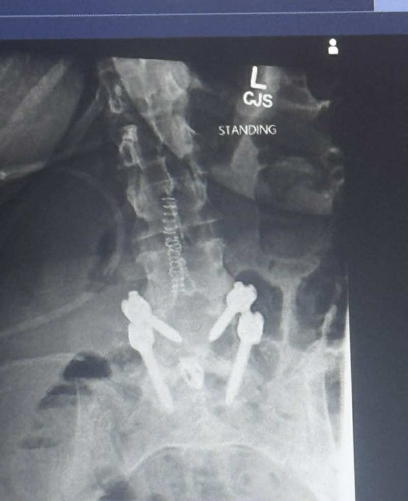 Help Kim Get Back on Her Feet After Emergency Spinal Surgery campaign photo, 2 of 7