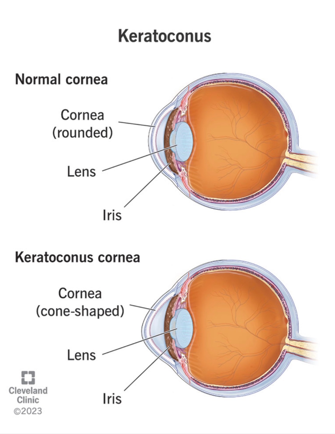 Support Her Eye Surgery and Recovery Costs campaign photo, 2 of 4