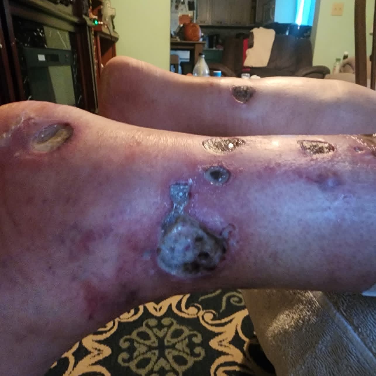 Support Sam's Healing Journey After Spider Bite campaign photo, 2 of 6