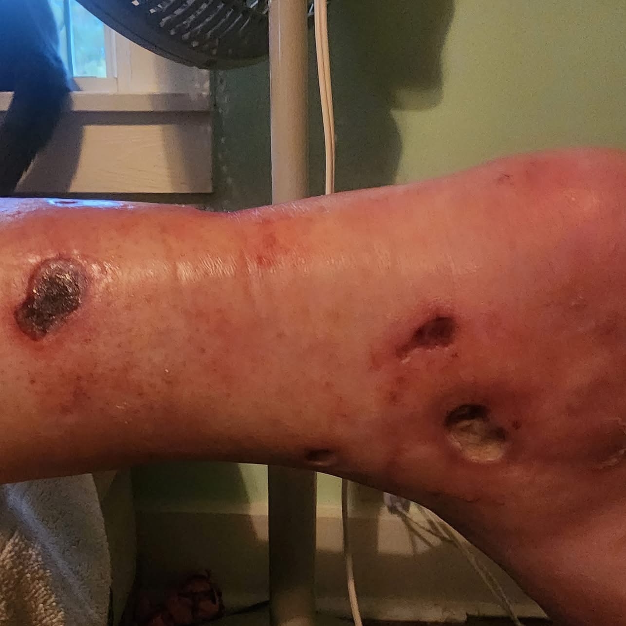 Support Sam's Healing Journey After Spider Bite campaign photo, 5 of 6